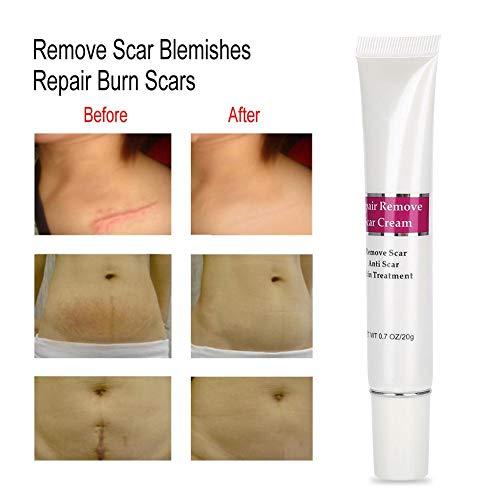 Acne Scar Removal Cream Repair Maternity Stretch Marks Gel Remove Burn Scars