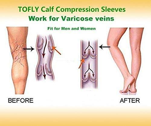 1Pair Calf Compression Sleeve 20-30mmHG Leg Warmer Varicose Vein