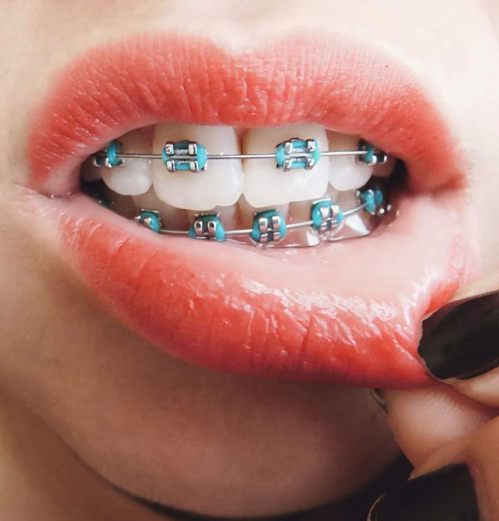 colored braces rubber bands