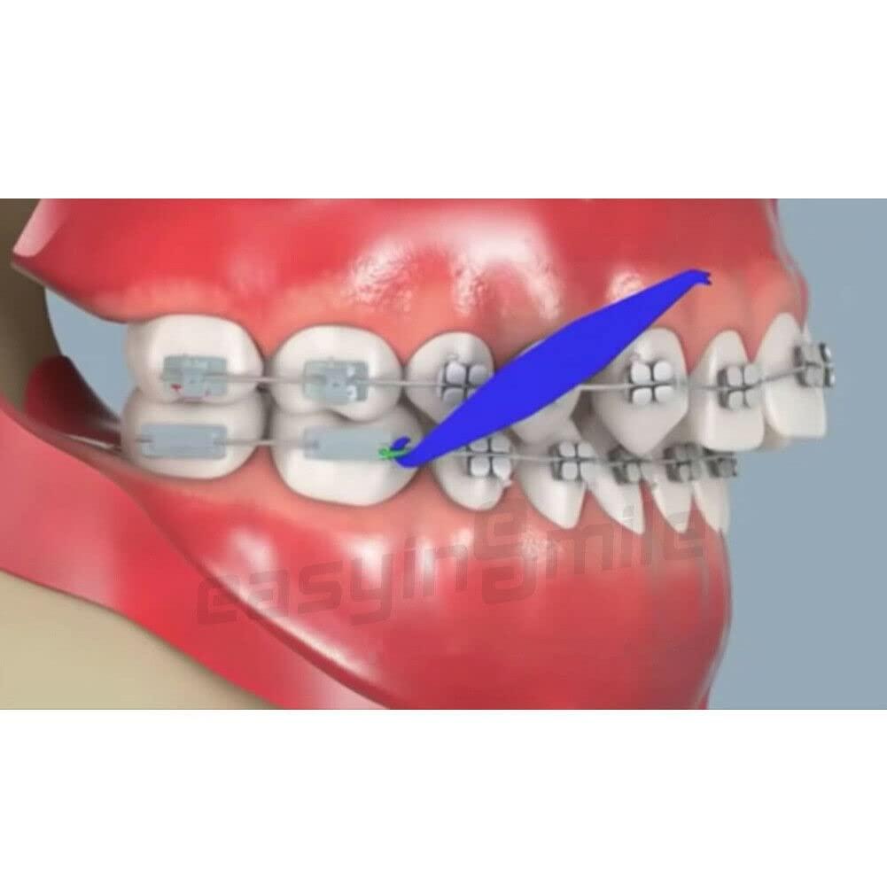 Dental Orthodontic Elastic Placer Hooks For Braces Elastic Rubber Bands  100Pcs