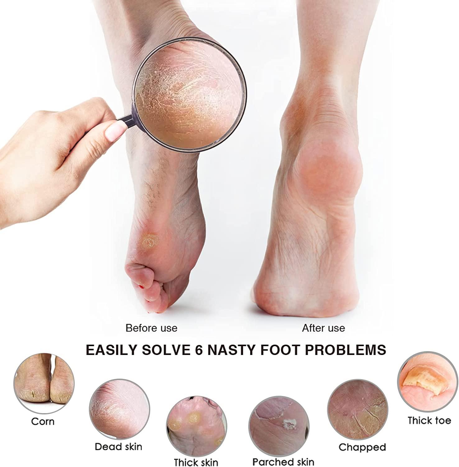 Natural Pumice Stone Foot Scrubber For Feet Dead Skin Callus Remover  Pedicure File Foot Grater Pedicure