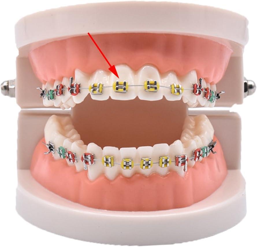 Treatment Auxillaries: Elastics (rubber bands) - Forbes Orthodontics