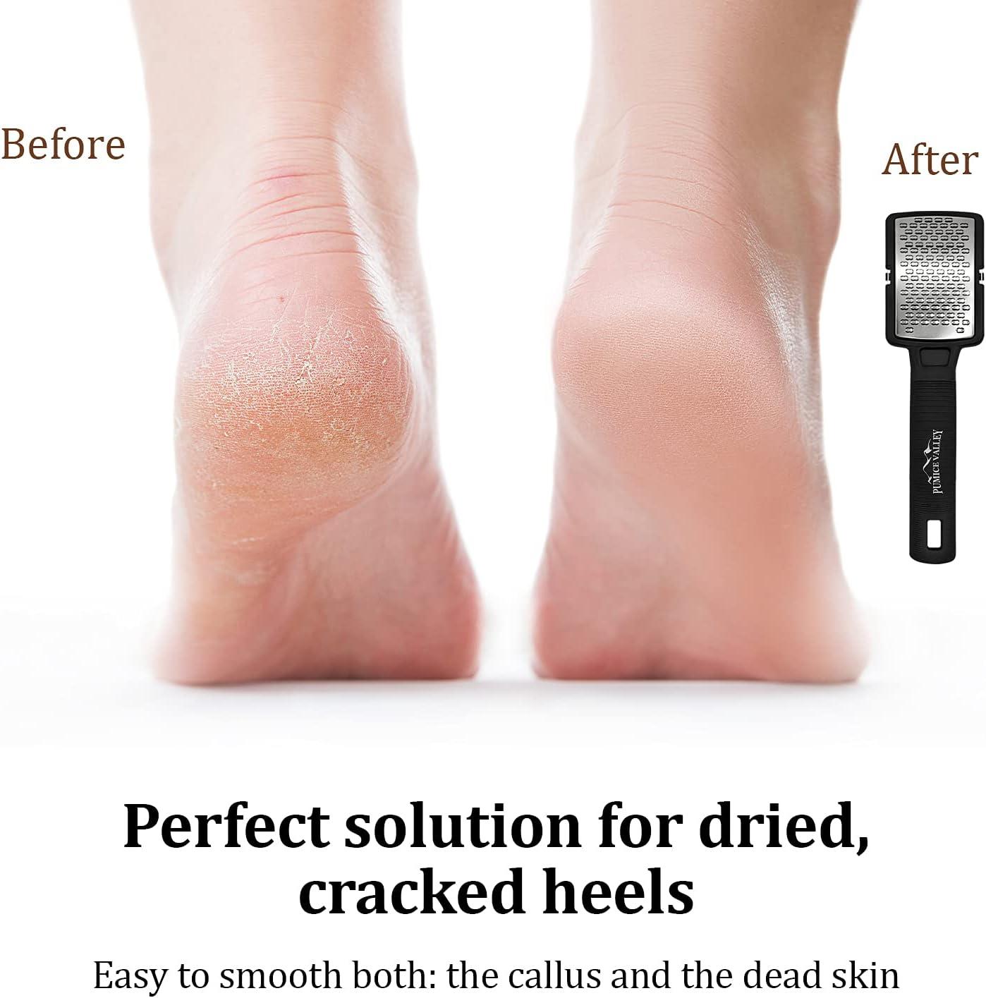 Foot File Callus Remover, Stainless Steel Foot Scrubber, File Cracked Heel  Scraper - Gilt [exquisite style] / high-grade coated handle + stainless