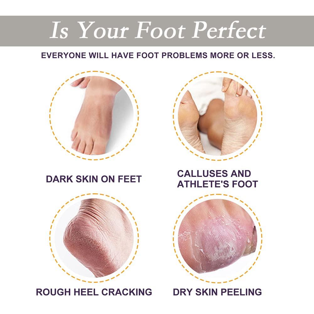 OLD DRY SKIN AND CRACKED HEEL REMOVAL BY MISS FOOT FIXER 