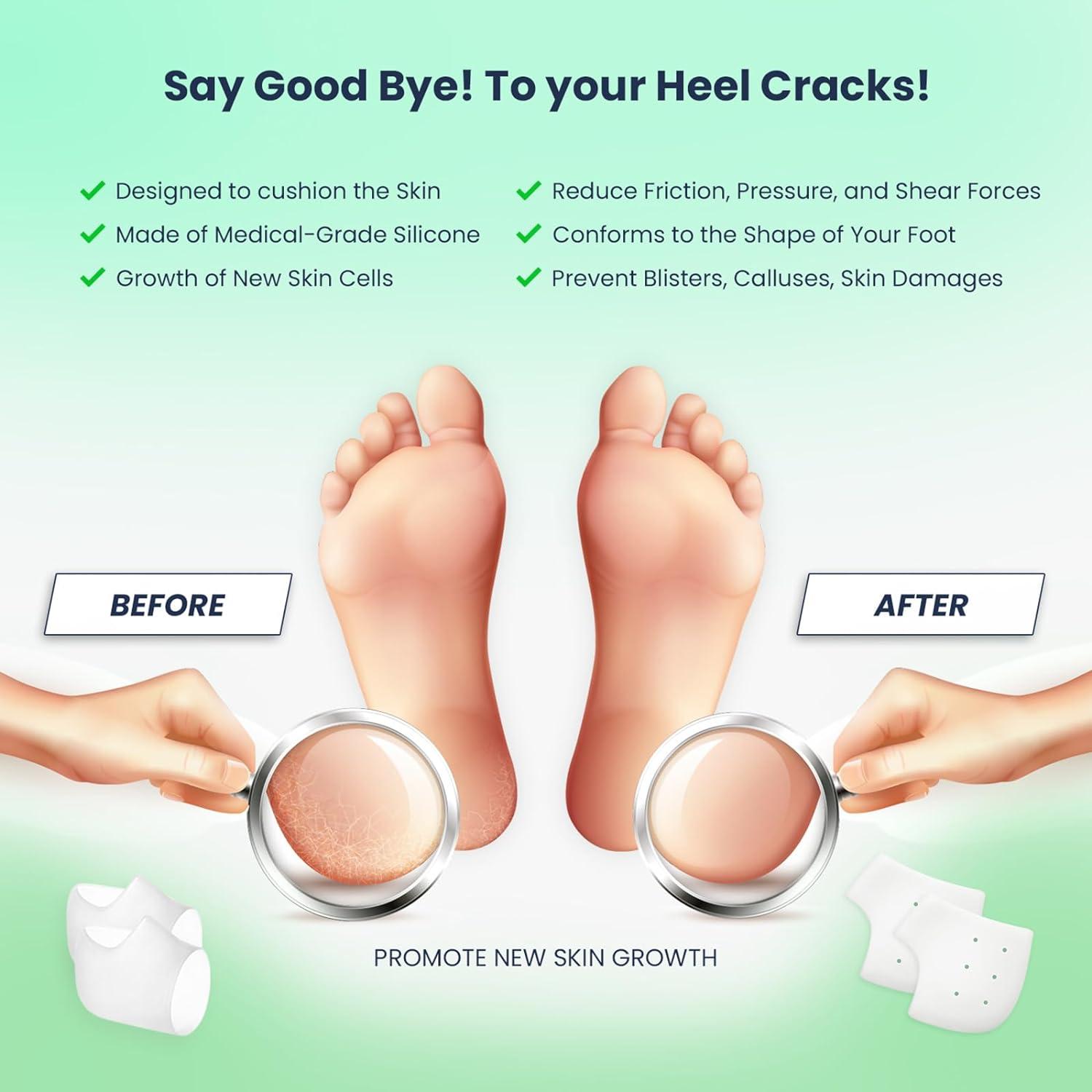 How To Heal Your Cracked Heels – Delfina Skin™