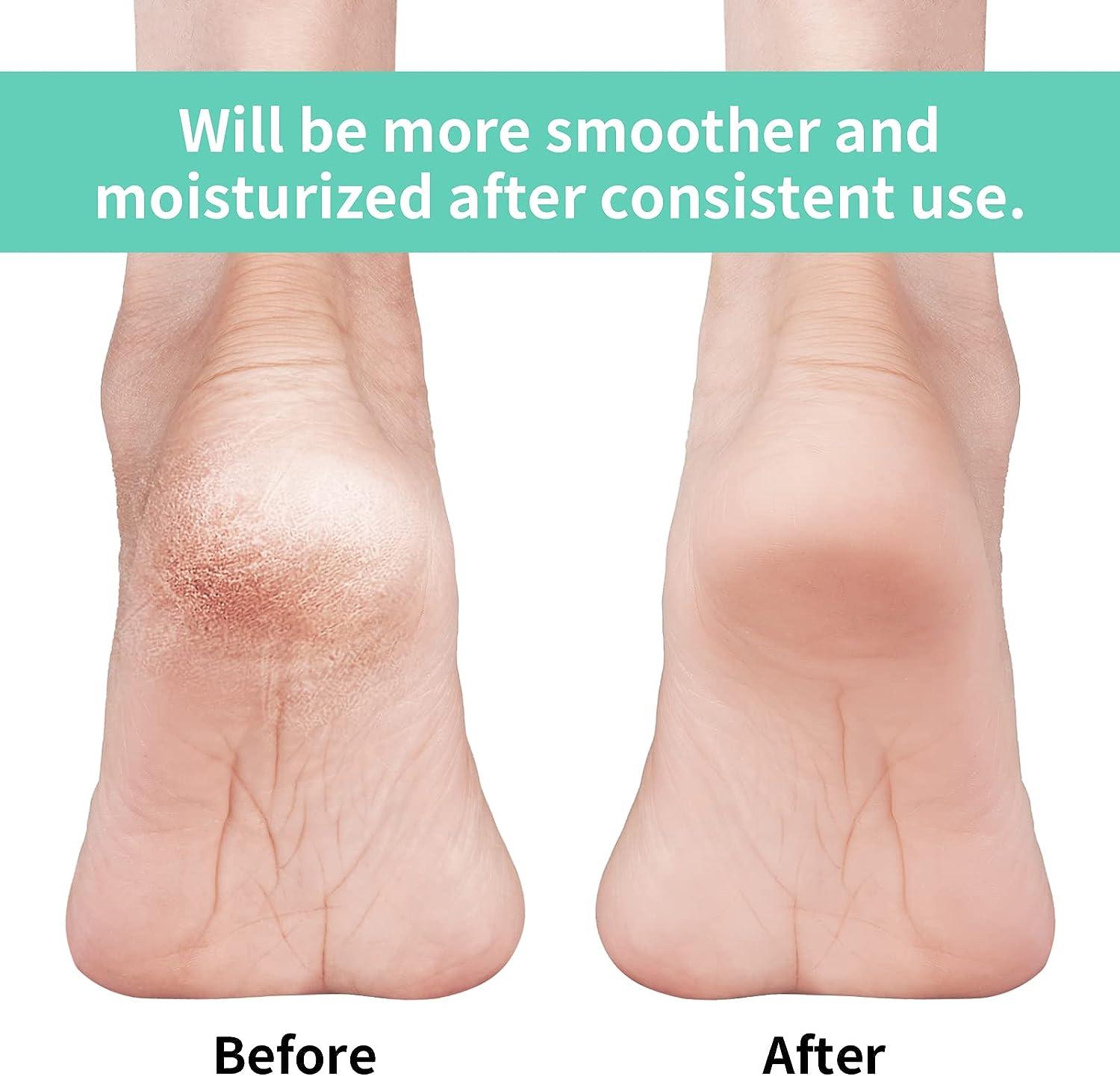 Amazon.com : Dr. Frederick's Original Moisturizing Heel Socks for Cracked  Heel Treatment - 2 Pairs - Heel Socks for Dry Cracked Feet - Cracked Heel  Repair - Heal Dry Heels - Foot