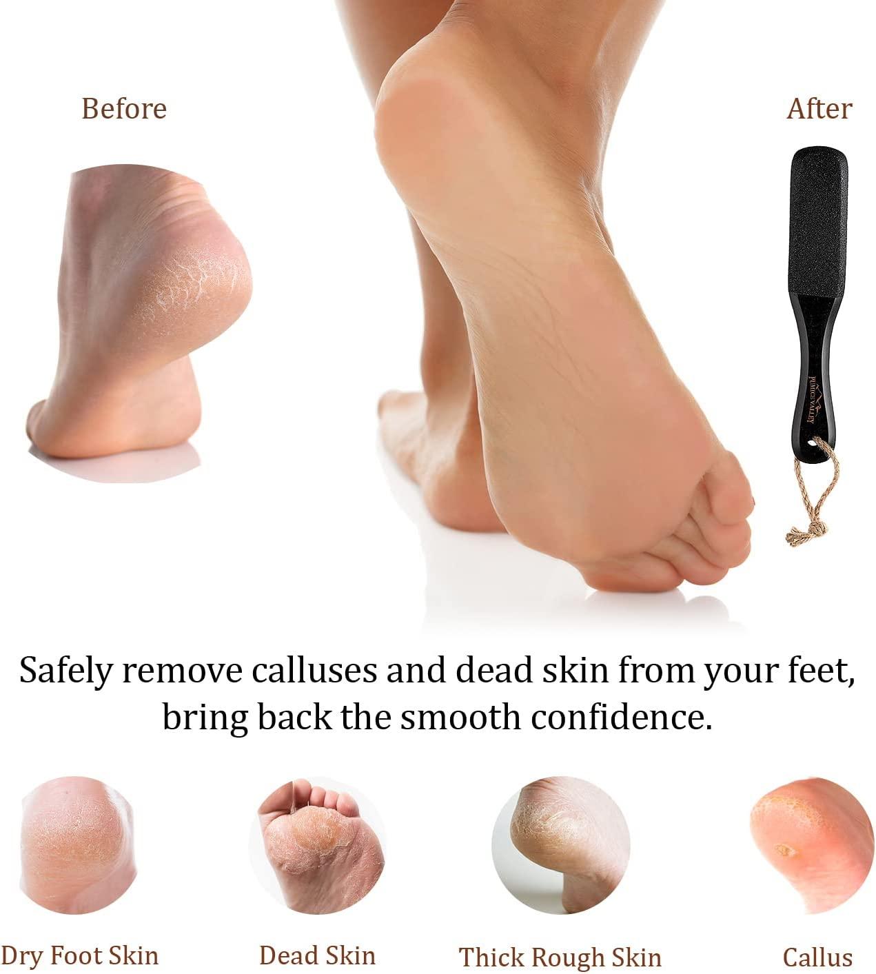 Callus Removal From Feet  Insane Pedicure 