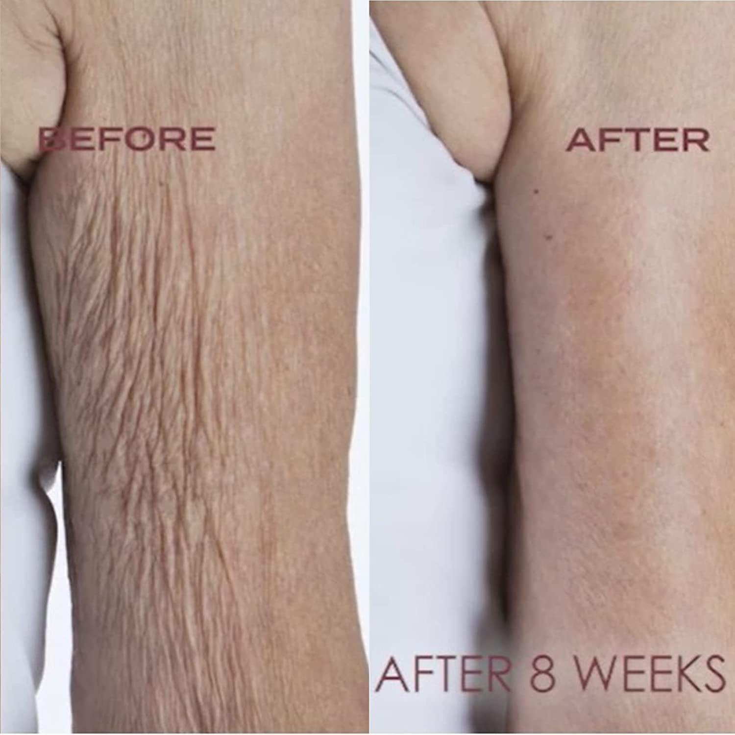 See the Before and After photos of how Crepe Erase has transformed people's  skin