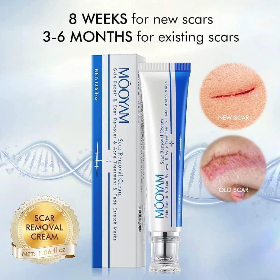Scar Removal Cream, Scar Removal Cream, Skin Repair Treatment For Stretch  Marks Burn Scars Incision Scars Operation Scars