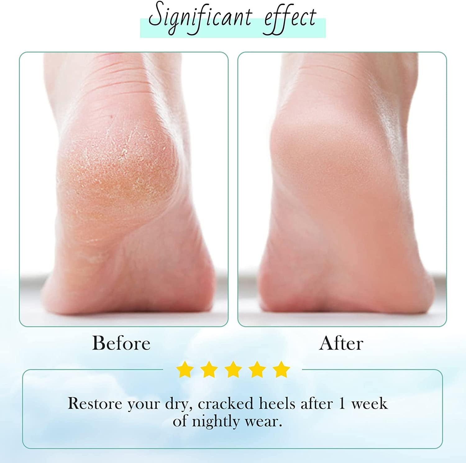 Treating and Repairing Dry Feet and Heels