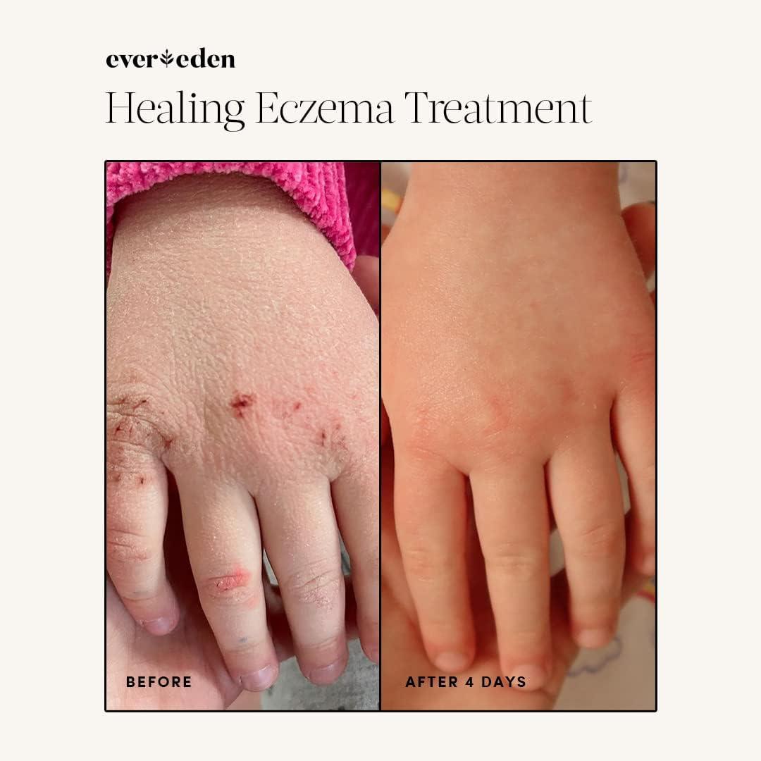  Evereden Healing Eczema Treatment, 1.7 fl oz, Plant Based and  Naturally Derived Eczema Cream