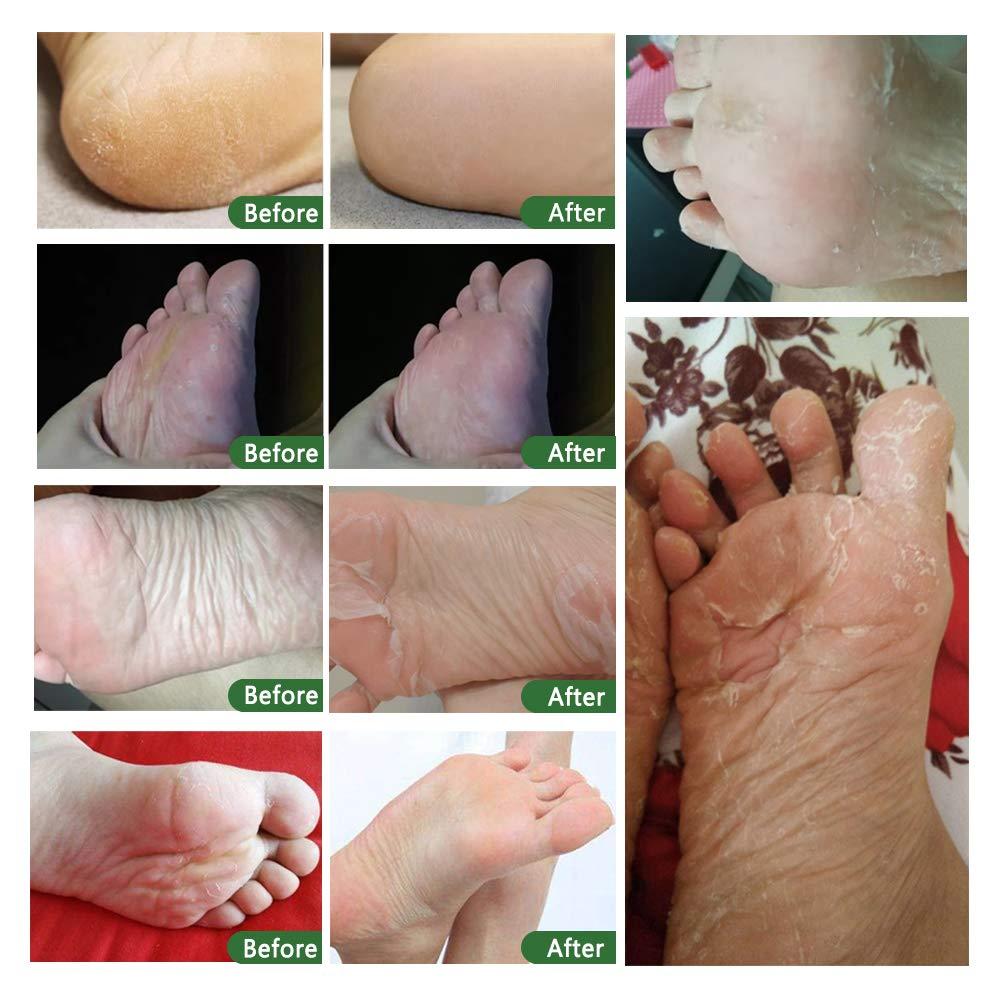 Tea Tree Foot Peel Mask For Dead Skin Callused and Cracked Heels Foot Mask  Removes Rough