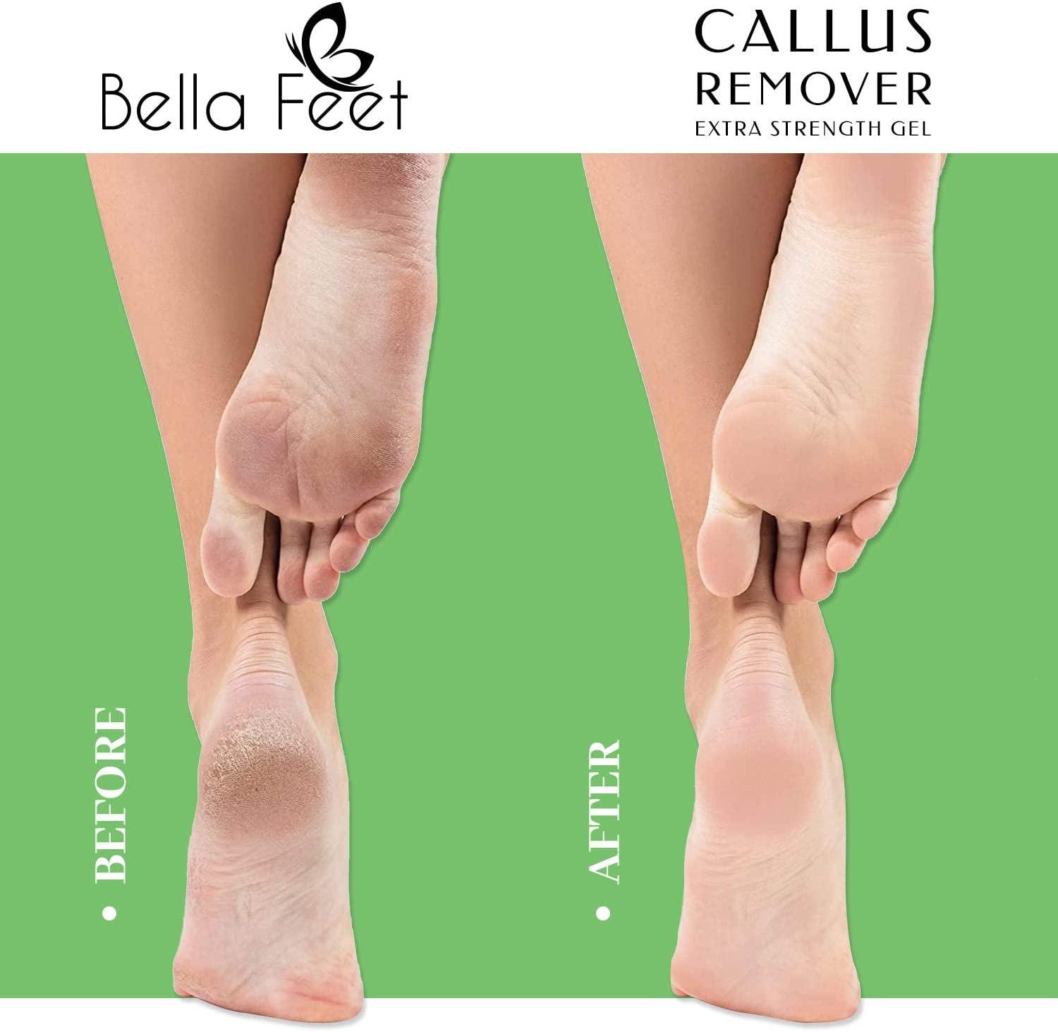 Bella Feet Callus Remover Kit Extra-Strength Callus Remover Gel with Foot  Scrubber, Gloves, Foot Repair Cream Professional Callus Remover for Feet  for Dry Cracked Heels 8.45oz 50ml