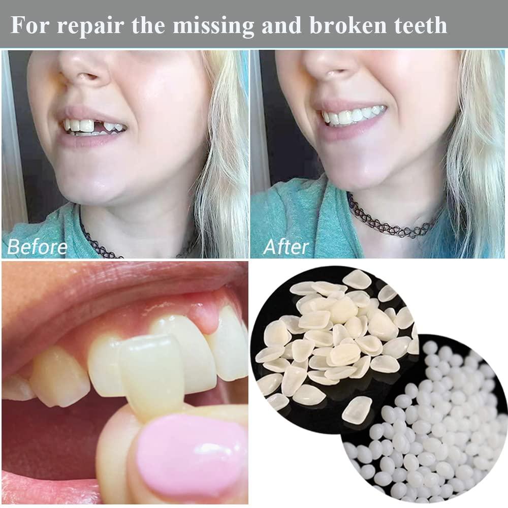 Teeth Repair Kit, Temporary Teeth replacement kit, Moldable False Teeth,  Thermal Fitting Beads for Snap On