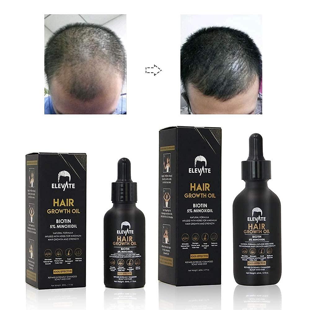 ELEVATE Hair Growth Oil - Biotin Hair Growth Serum & 5% Minoxidil ...