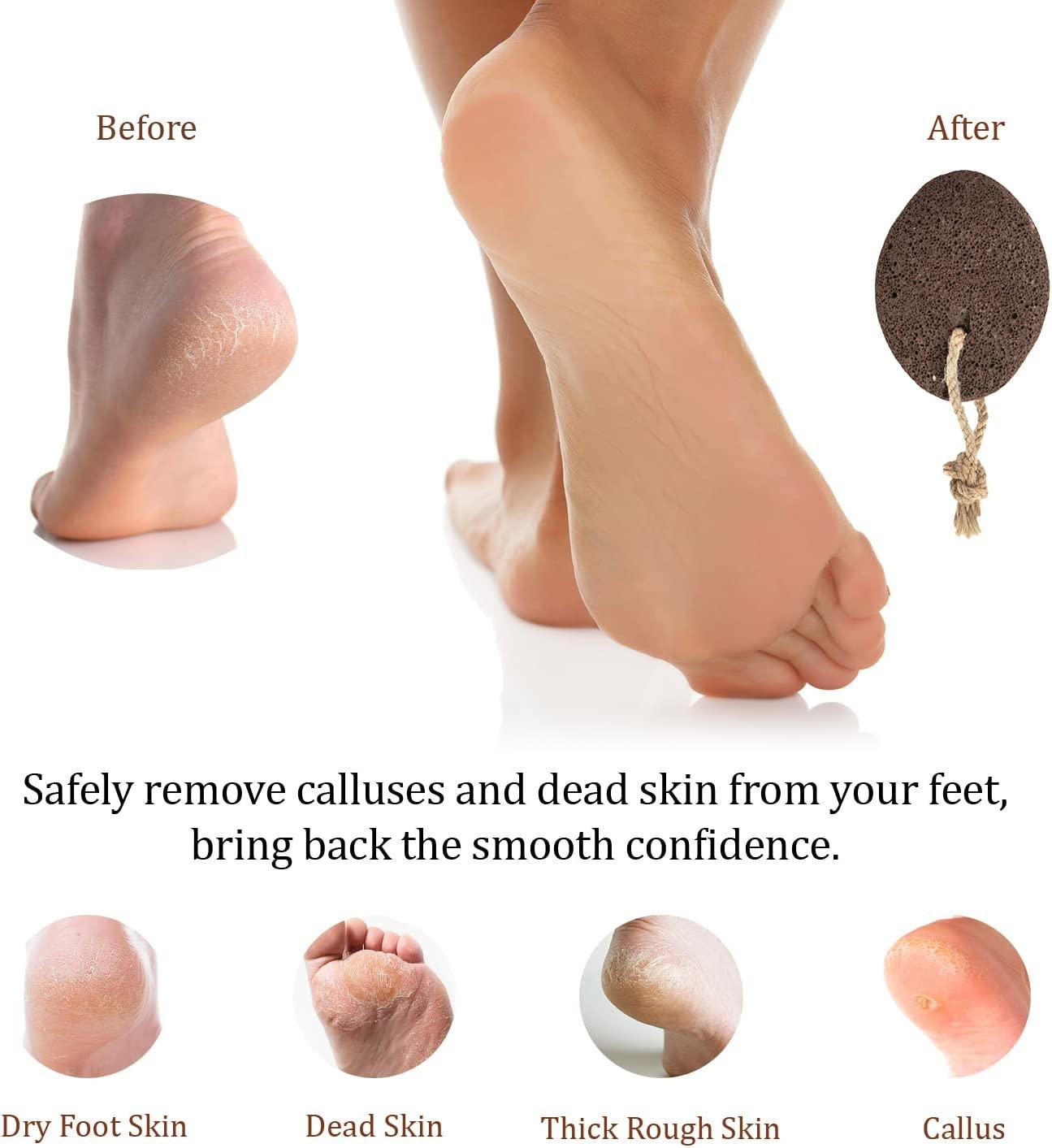 Foot Pumice Stone For Heavy Callused Feet Hands Dead Skin - Temu