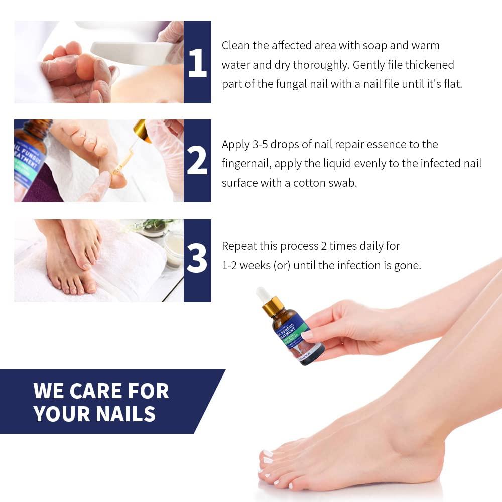 Laser Nail therapy Clinic Westminster CO | Laser Nail Fungus Treatment