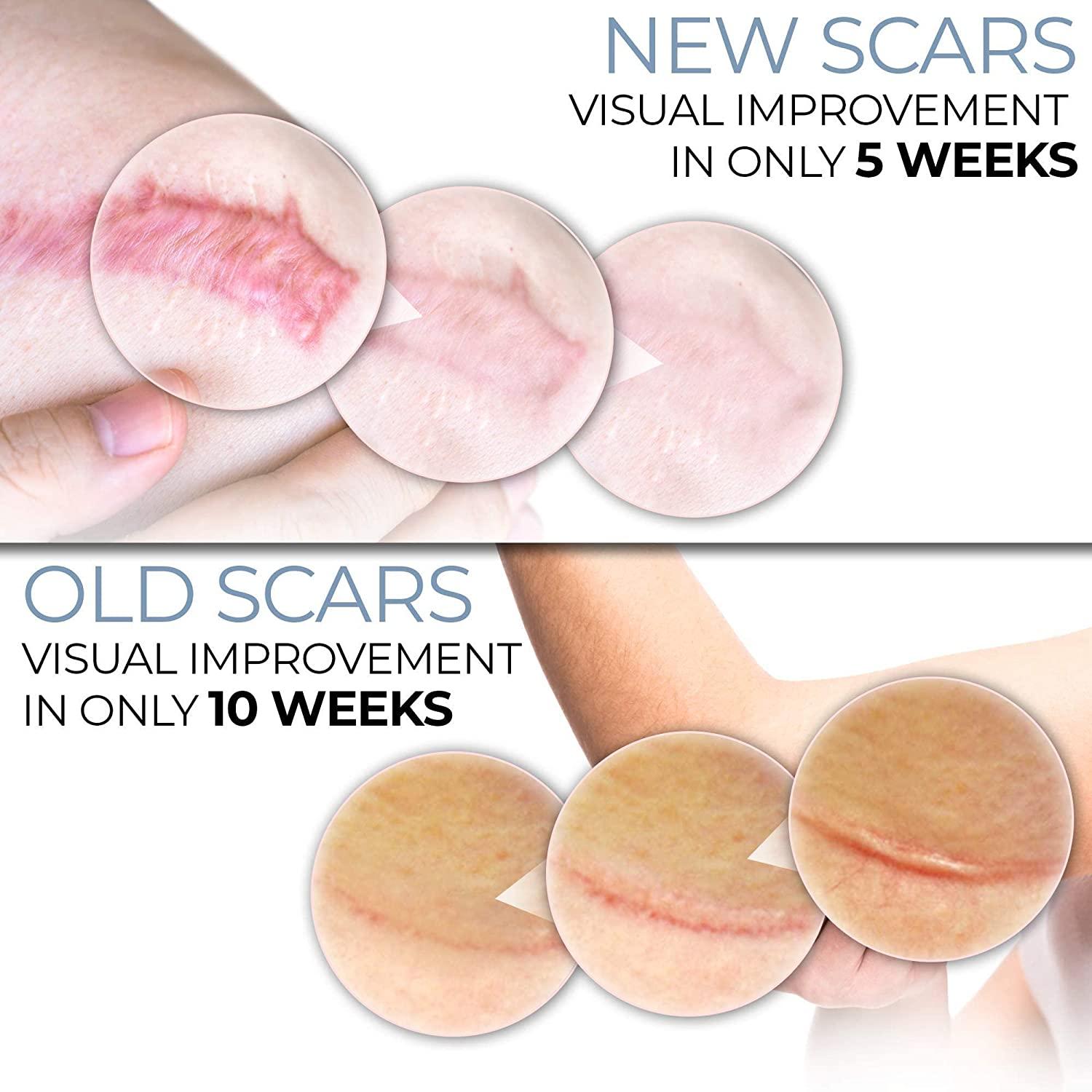 IS SILICONE SHEETING OR GEL BETTER FOR SCARS? - Scarless Canada