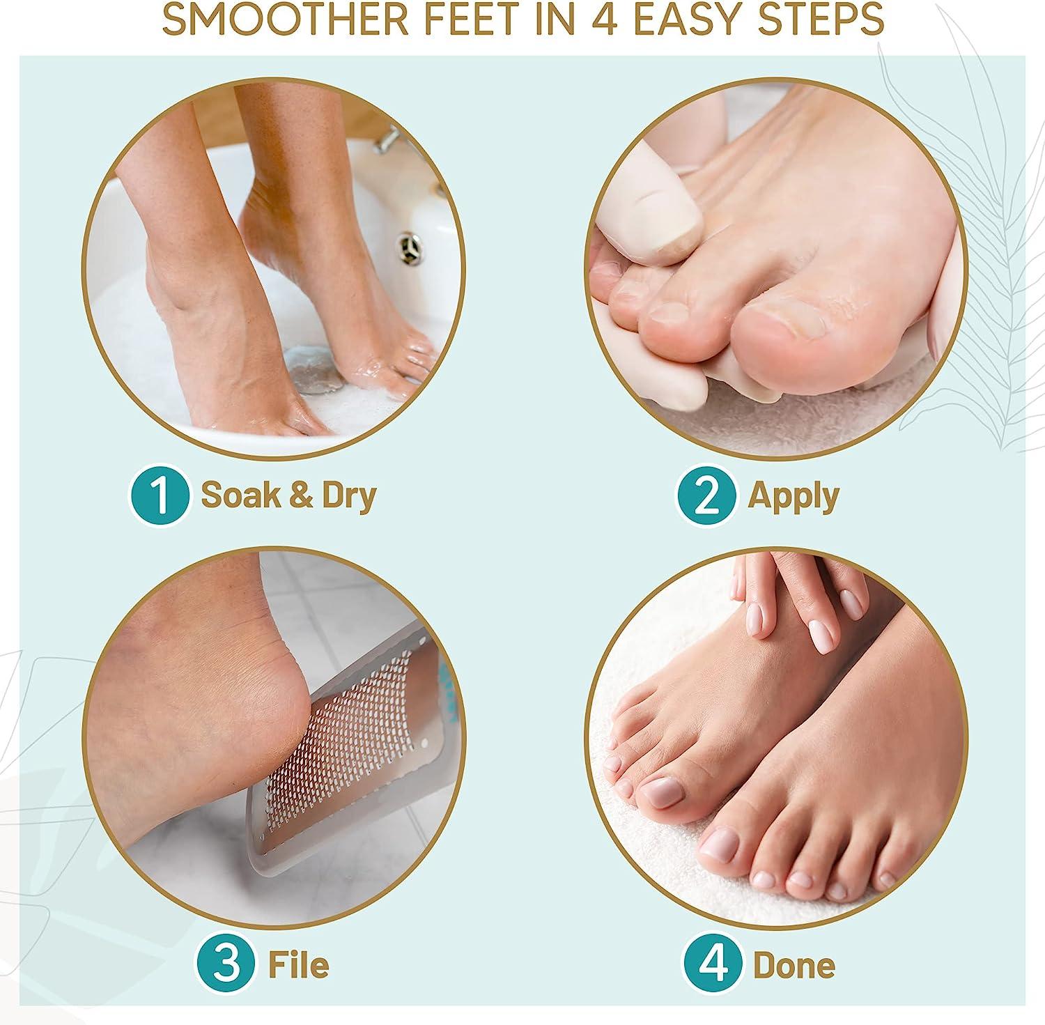 Corn and calluses remover Gel Foot callus removal treatment Hard skin  Pedicure