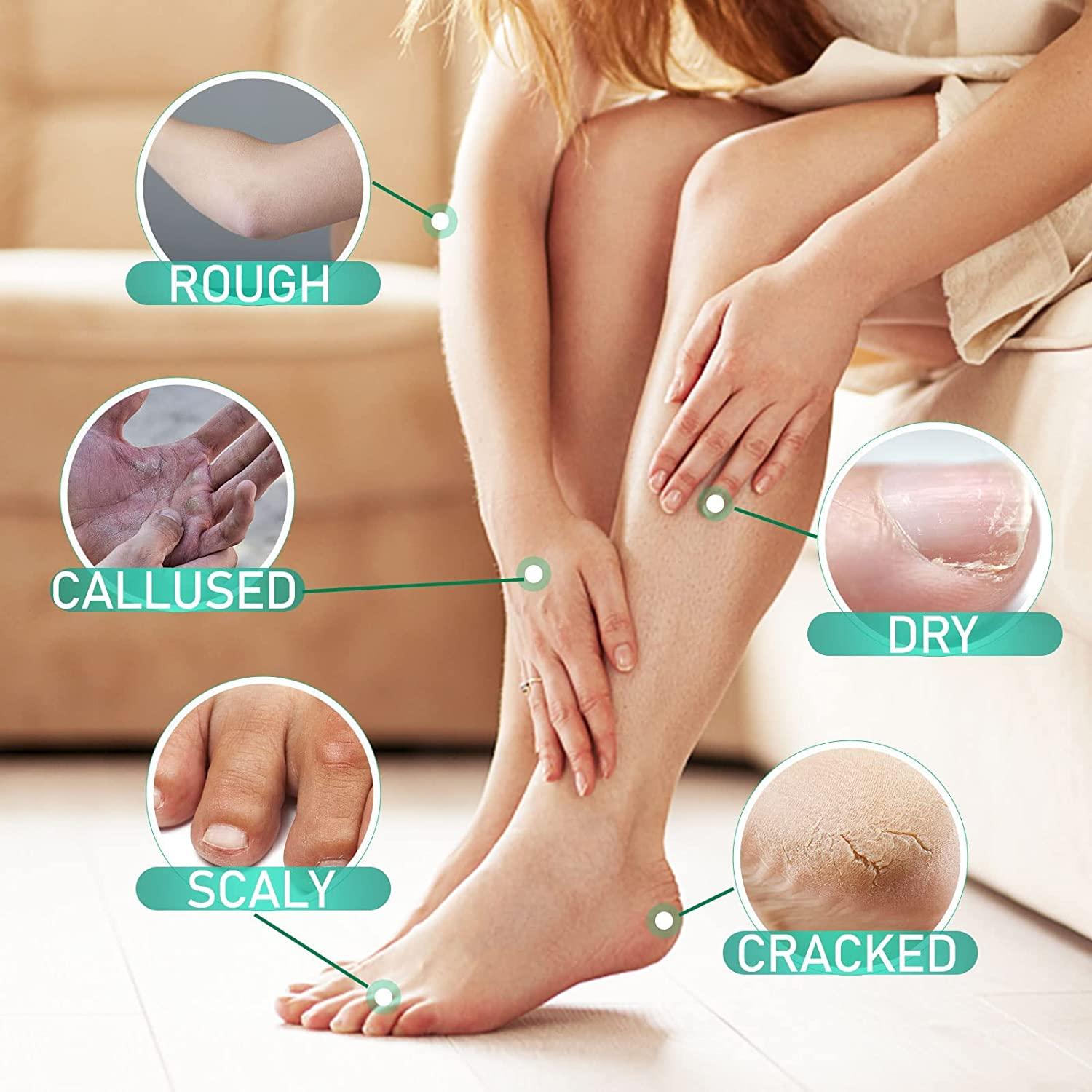 Ellgy Plus Cracked Heel Cream for Rough Dry Foot 50 G. | Cracked heels, Dry  foot, Cream