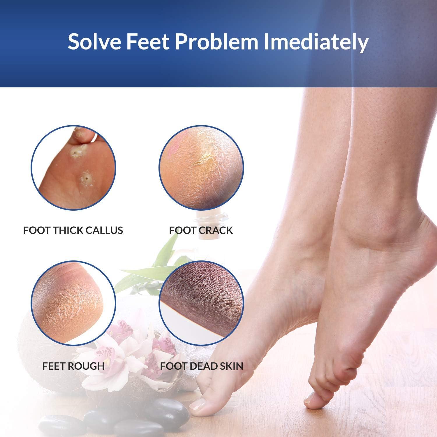 COMGO Metal Pedicure Foot File Callus Remover for Feet (1  Piece),Double-Side Foot Scrubber Foot Scraper for Dead Skin Professional  （Black)）