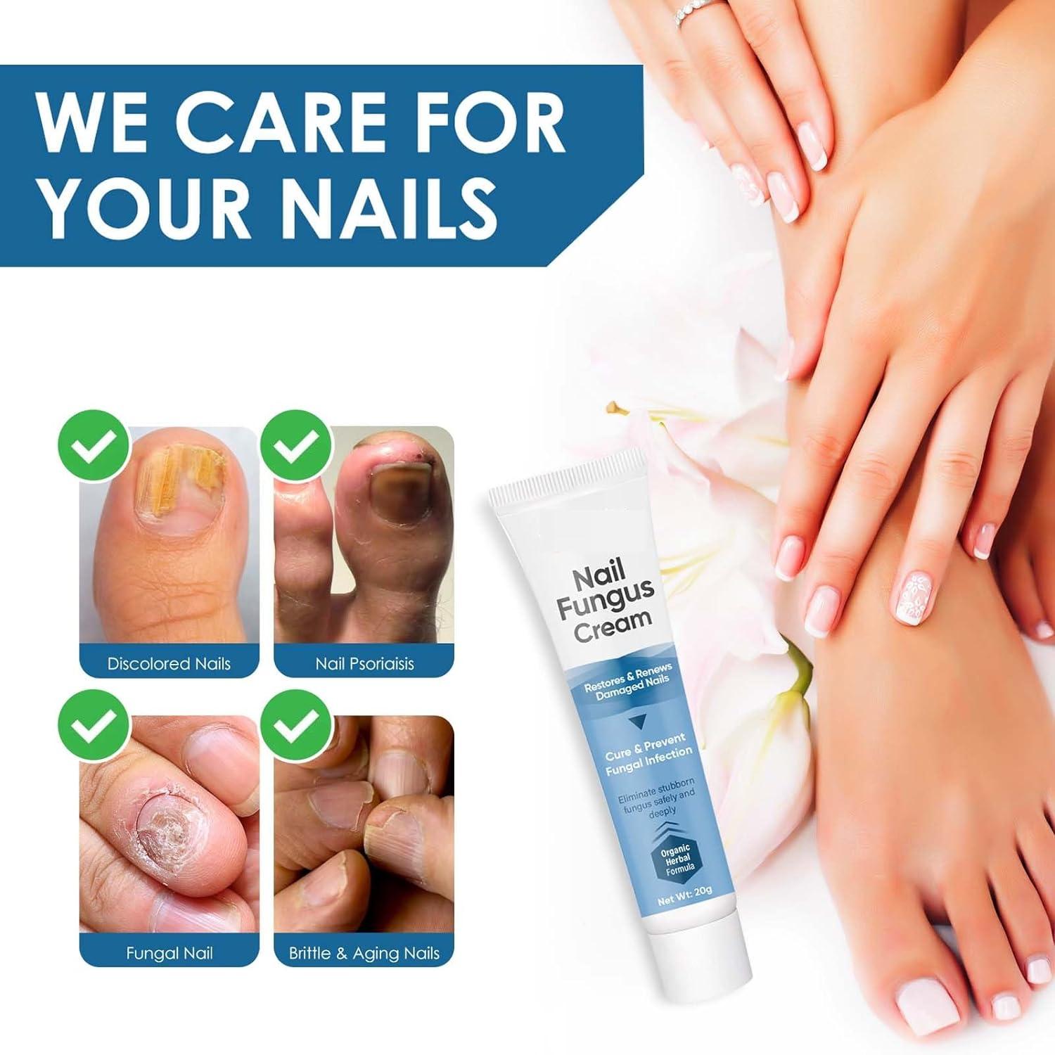 Nail Fungus Treatment at best price in Surat | ID: 2851484360291