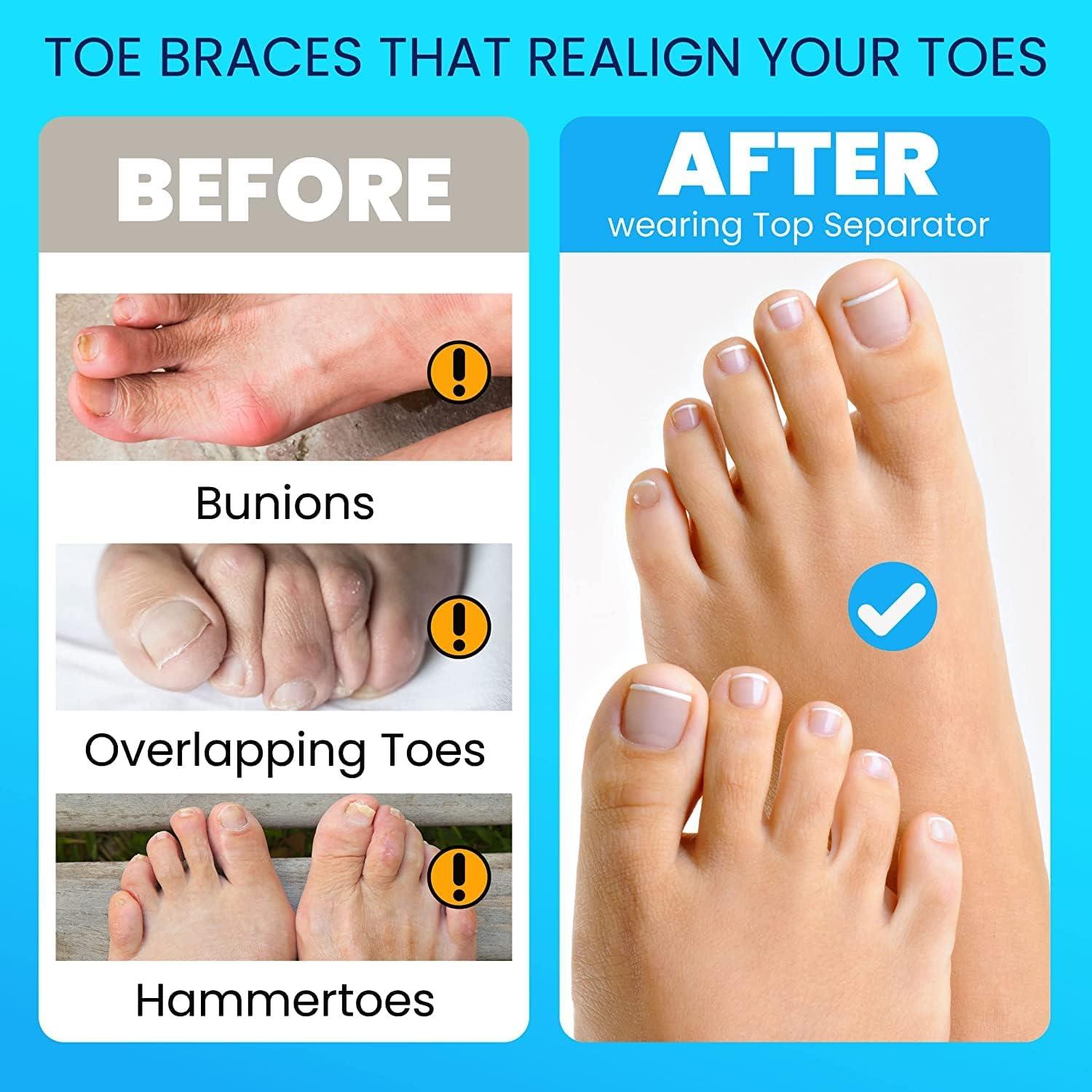 Correct Toes - Natural Orthotics/Toe Spacers – P.R. GEAR