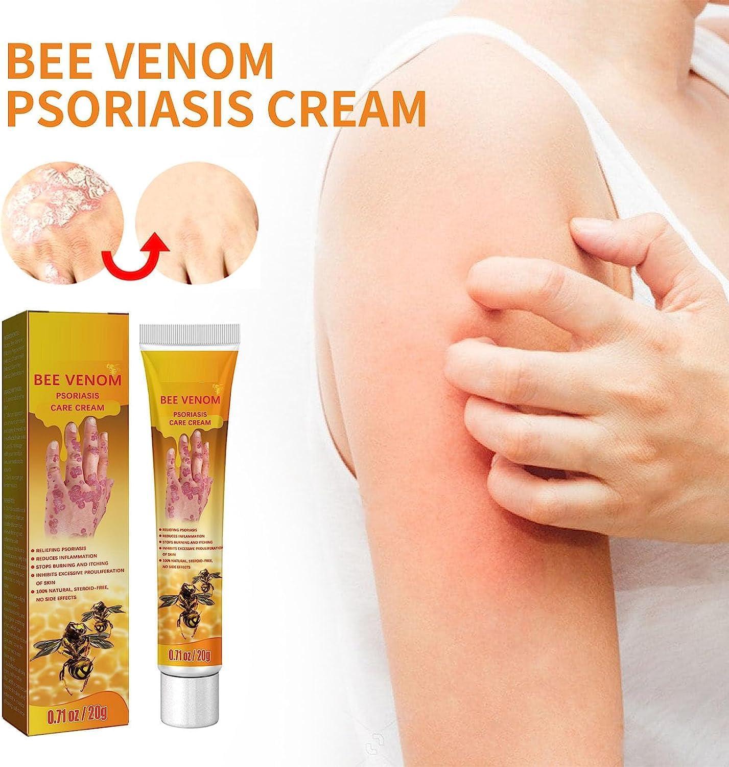 HEKEWER Youth Bee Venom Psoriasis Treatment Cream New Zealand Bee Venom  Professional Psoriasis Treatment Cream Soothing Moisturizing Psoriasis  Treatment Cream for All Skin Types (1pcs)