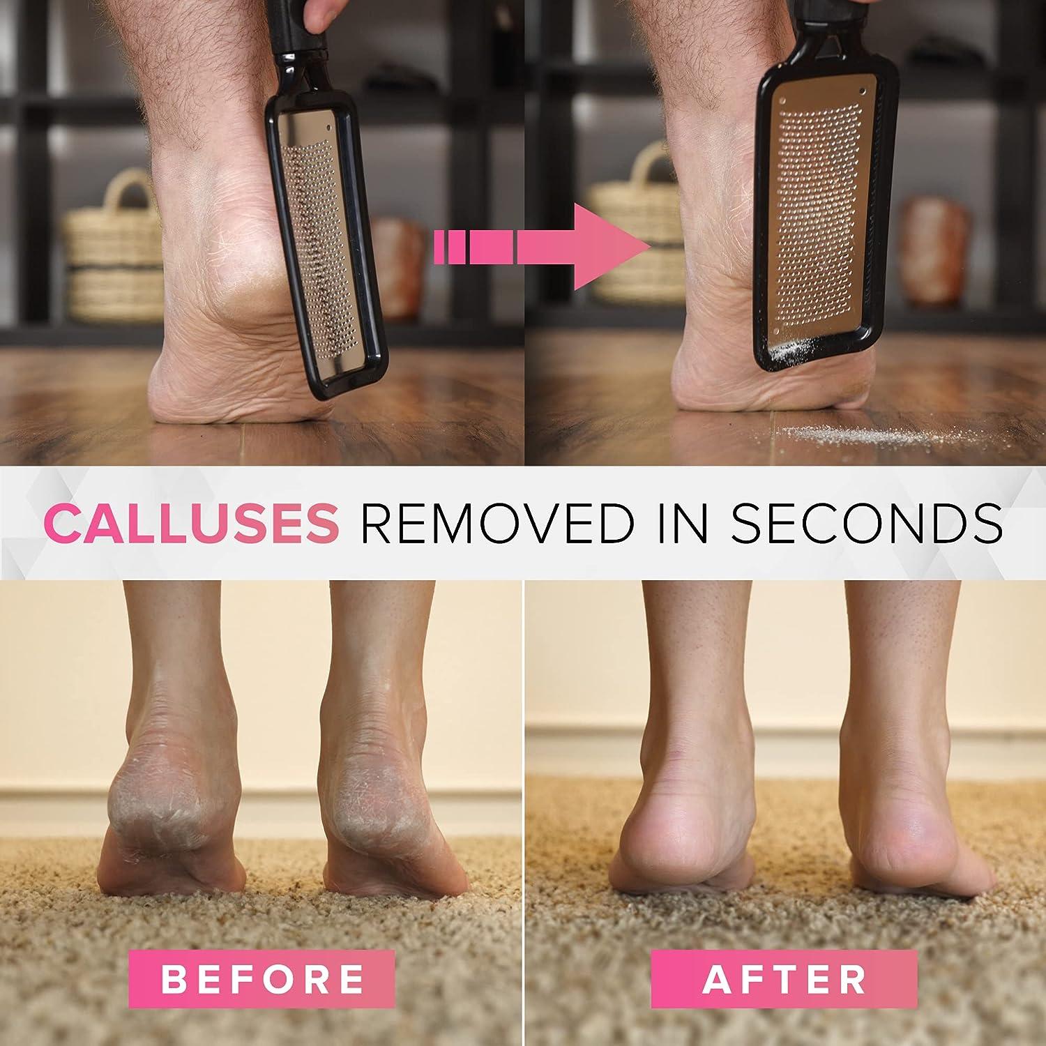 Foot Scraper Callus Remover,Corn Callous Removers,Foot Care Pedicure Callus  Shaver Hard Skin Remover,Foot File Foot Scrubber Stainless Steel Heel