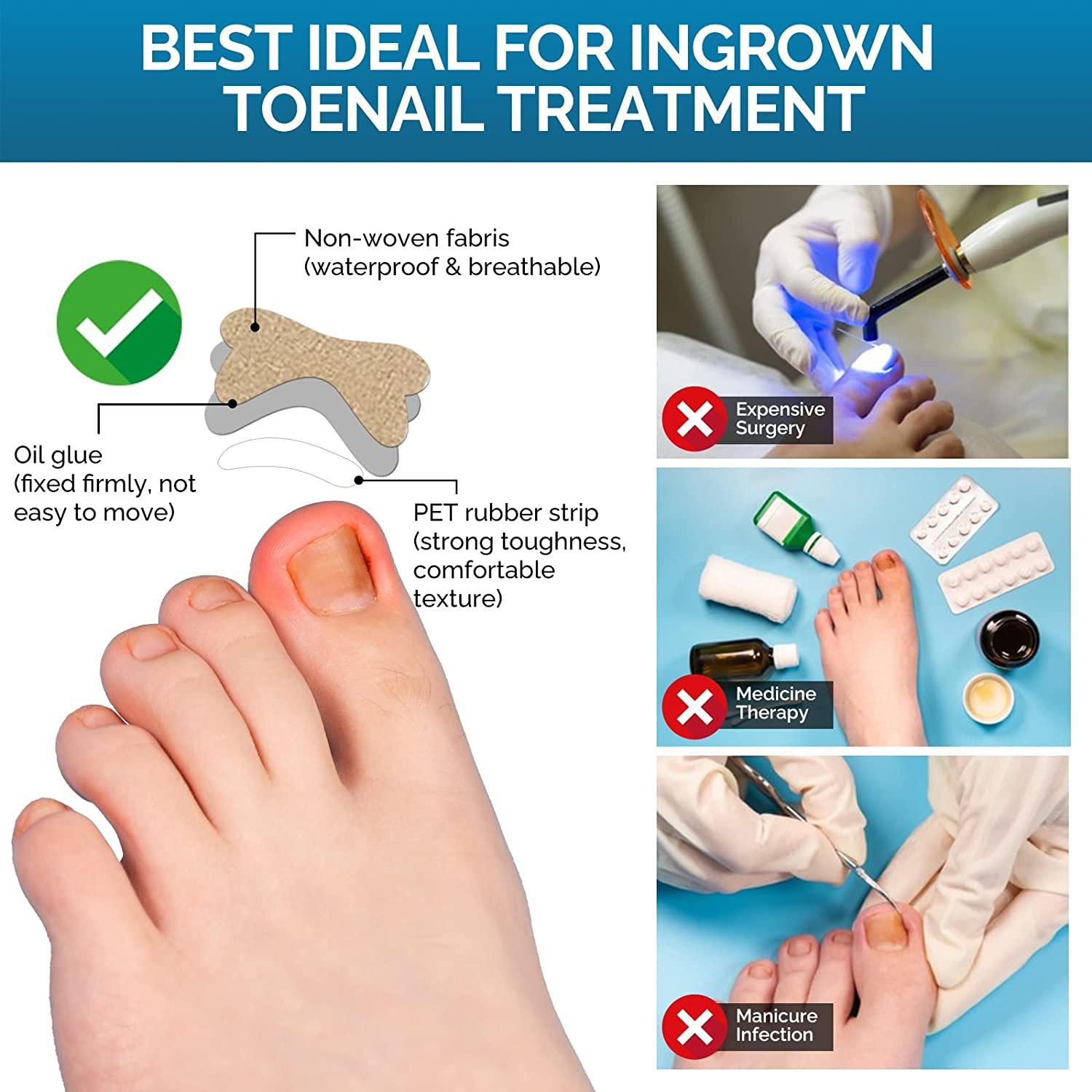 What are ingrown toenails and how are they treated?