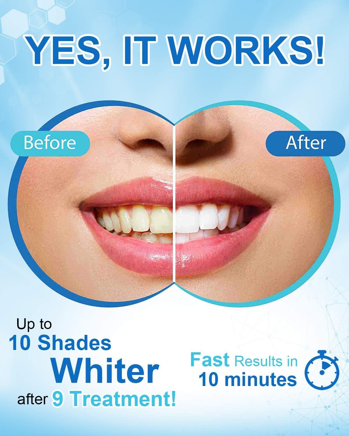 My teeth look PERFECTLY white!' This $19.99 tooth whitening pen