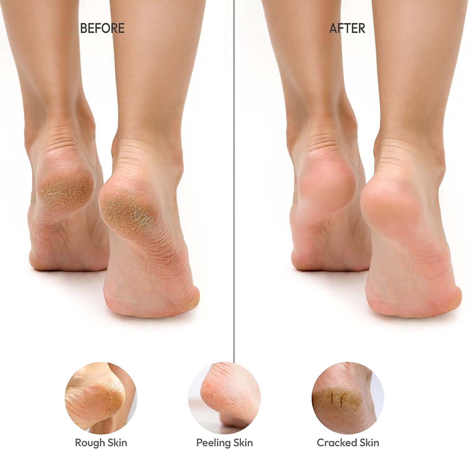 Ped Egg Callus Hard Skin Remover Pedicure Beautiful Feet The Ultimate Foot  File