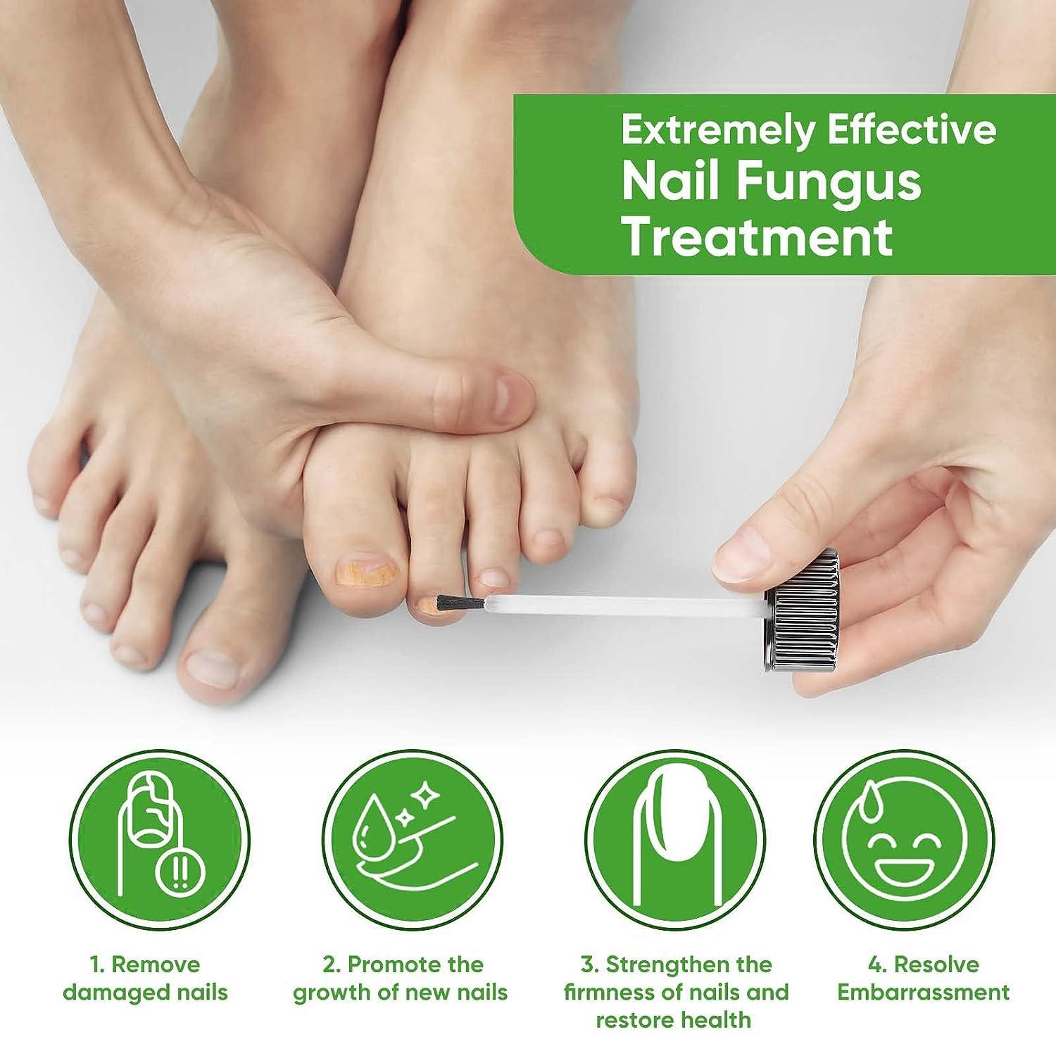 Toenail Fungus Treatment Extra Strength - Fungal Nail Treatment for Toe  Nail & Fingernails - Nail Repair Solution for Thick broken Discolored Nails  - Renews Damaged Cracked Ingrown Toenail - Tea Tree