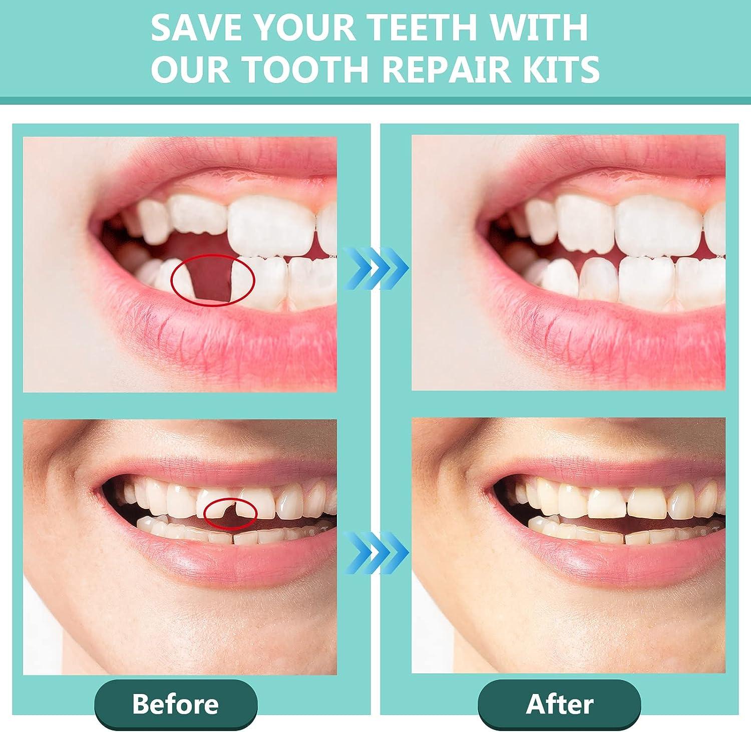 2023 Tooth Filling Kit Temporary Dental Repair Cement Teeth Gap