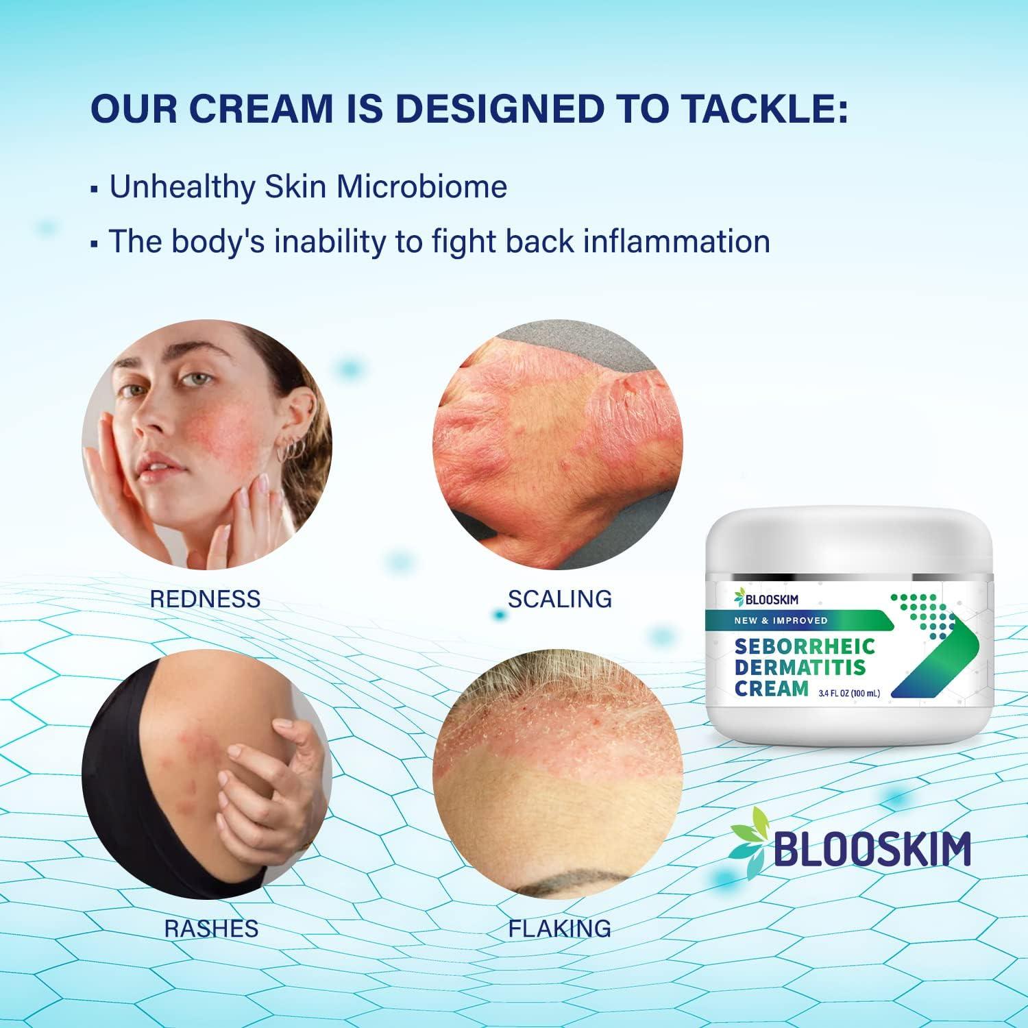 Blooskim Seborrheic Dermatitis Cream Fast Acting Treatment For Face