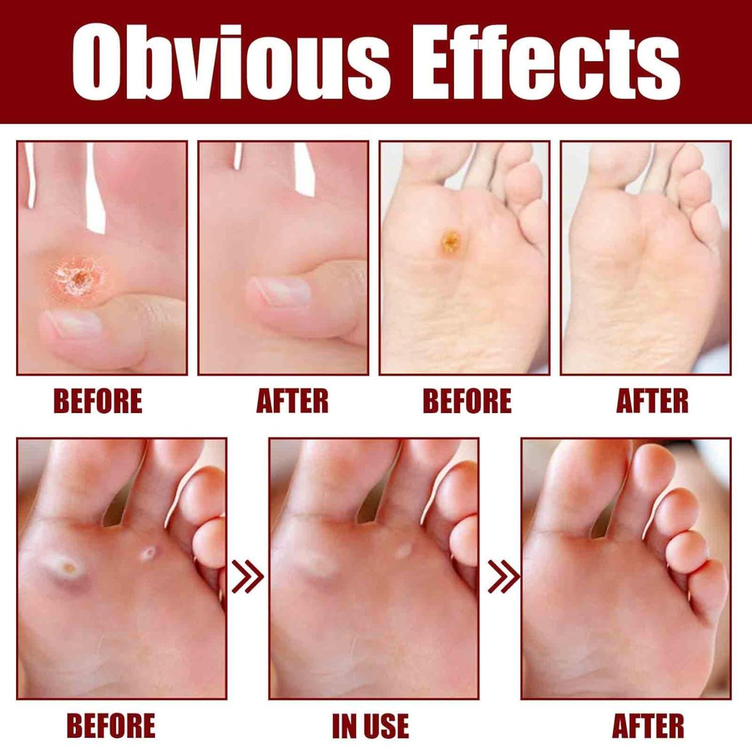 KODEQ Foot Corn Removal Extra Strengthen Gel Foot Corn Removal Cream Callus  Remover Liquid Liquid Corn Treatment and Callus Remove for All Skin Types  (1 pcs)
