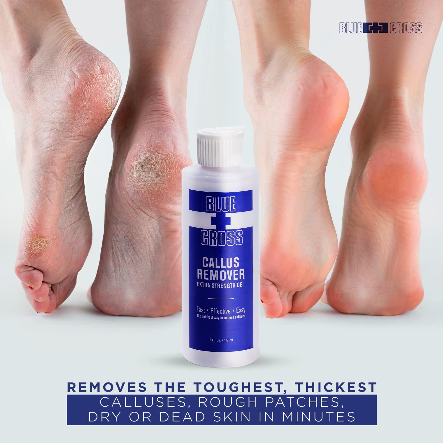 Foot Callus Remover Gel 6oz Callus Remover For Feet & Dead Skin, Foot  Scrubber
