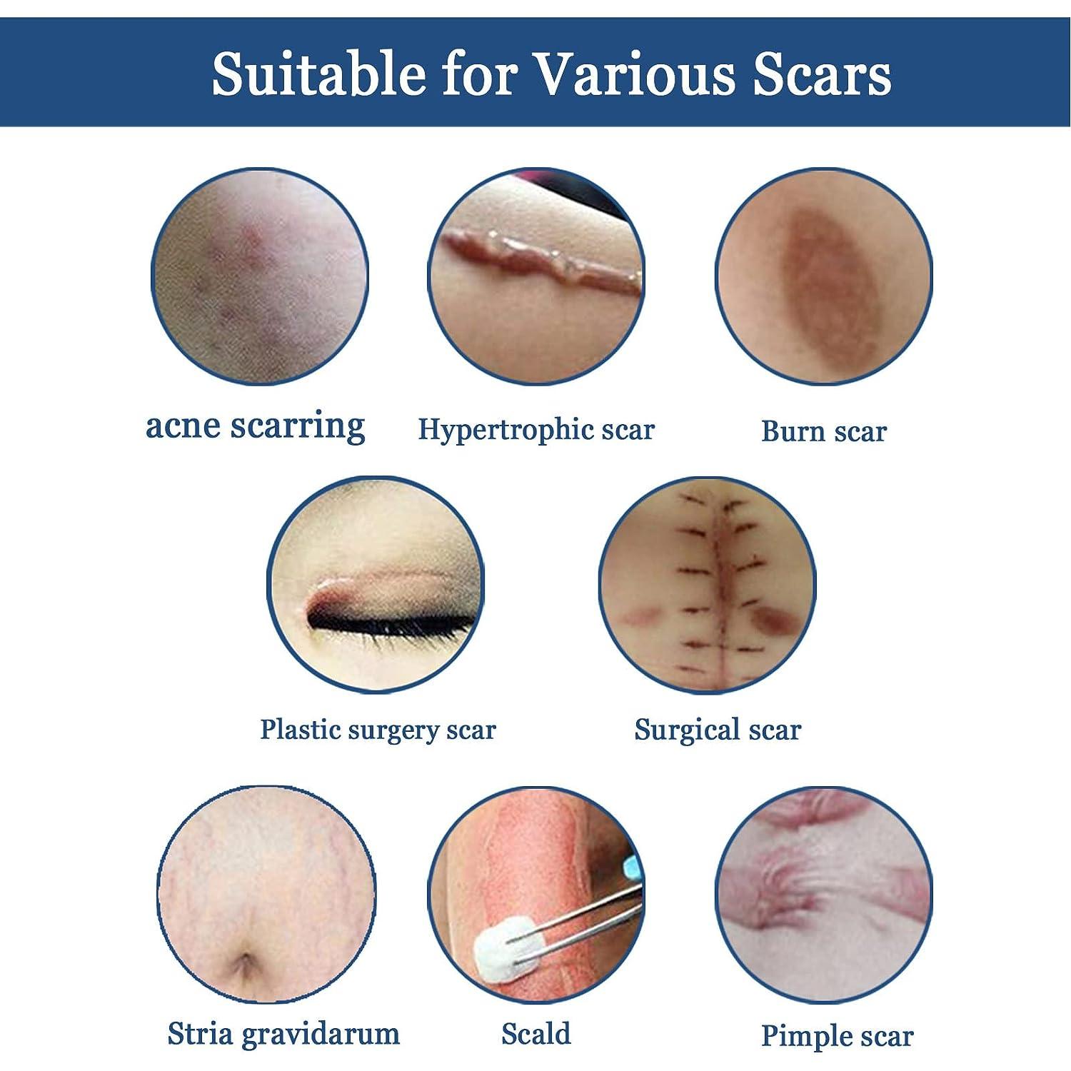 GHPKS Gentle Scar Removal Paste, Scar Repairing Diminishing Skin Scar Gel,  Scar Reduce Paste For All Skin Types