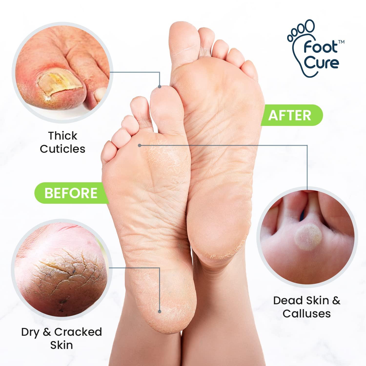 Soothing Lavender Foot Soak & Callus Remover Gel Kit - Moisturize, Hea –  Foot Cure