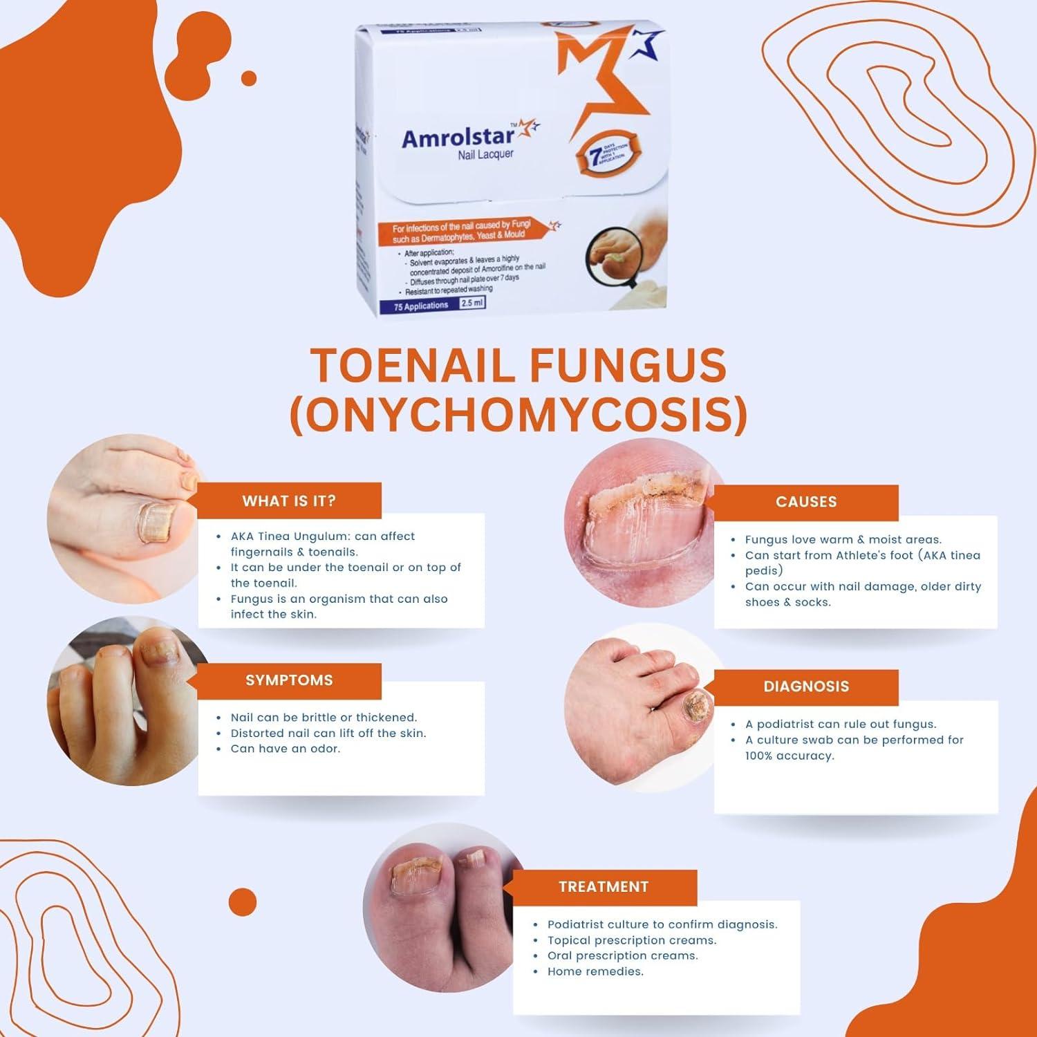 Effective Treatments for Toenail Fungus - GoodRx