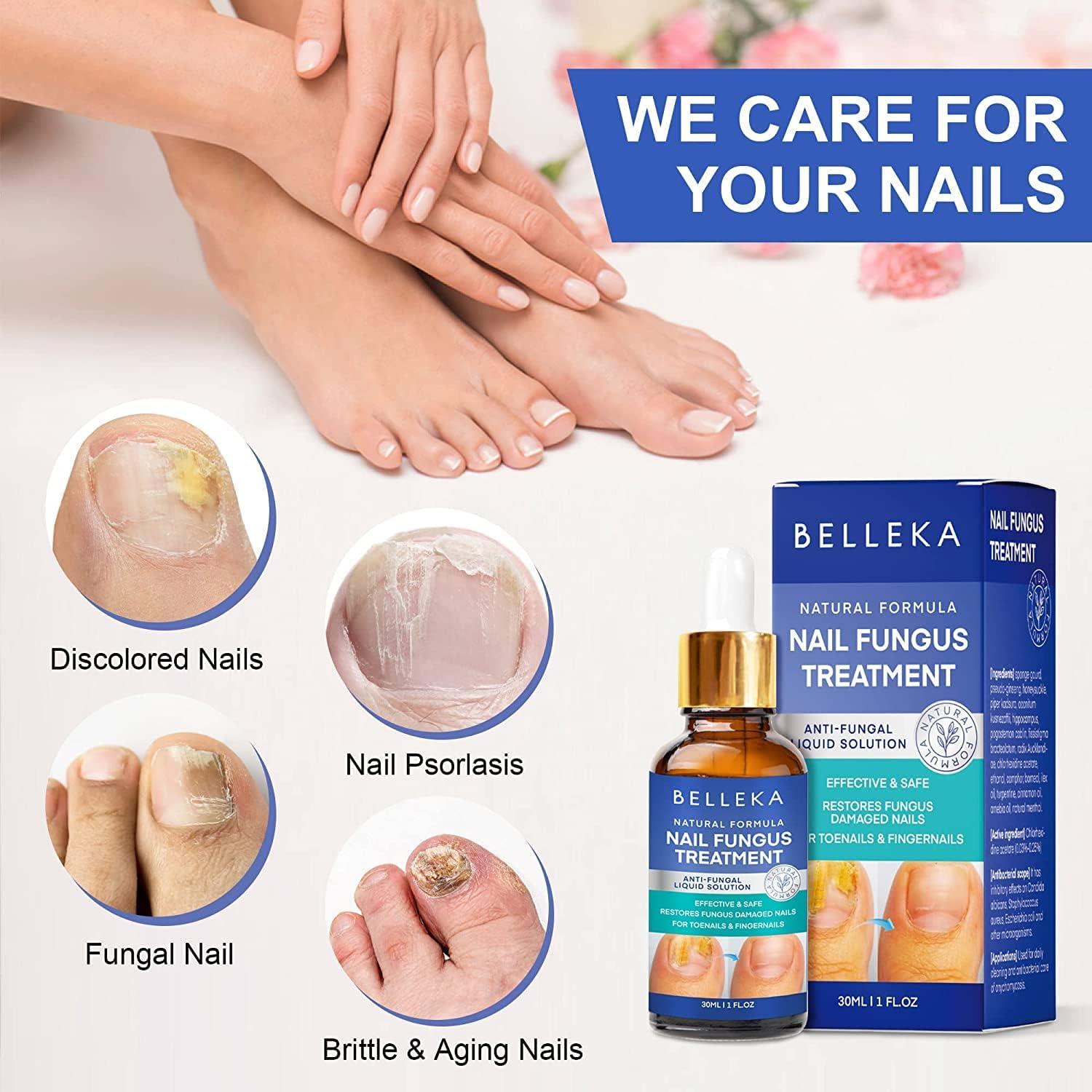 Amazon.com: Toenail Fungus Treatment-Extra Strength Nail Fungus Solution  for Toenail & Fingernail, Repair Liquid for Thick Cracked Discolored Nails,  Restore Nail Health : Everything Else