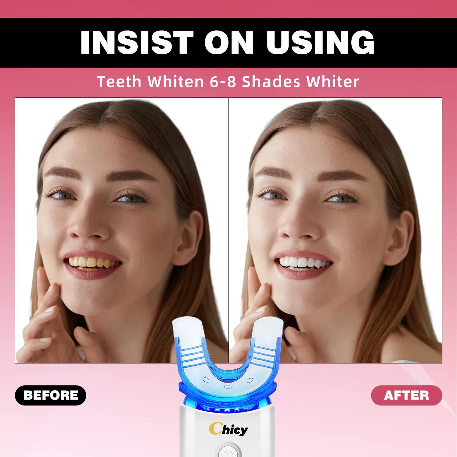CHICY Teeth Whitening Kit, Teeth Whitening Gel with LED Accelerator Light  and Tray Teeth Whitener Helps to Remove Stains from Coffee, Smoking, Wines,  Soda, Food