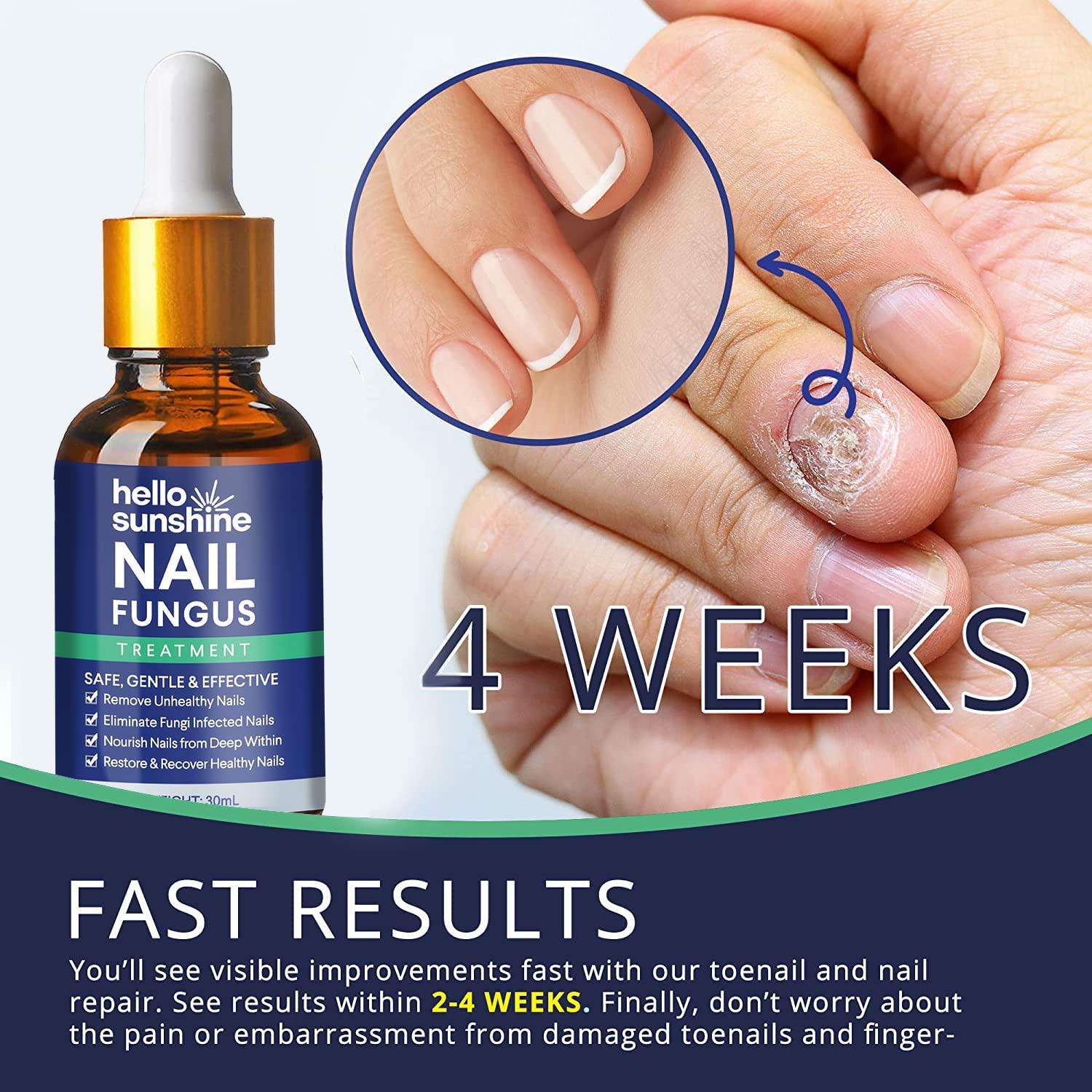 Pro Anti Fungal Nail Treatment Repair Finger Toe Care Nail Fungus Liquid |  eBay