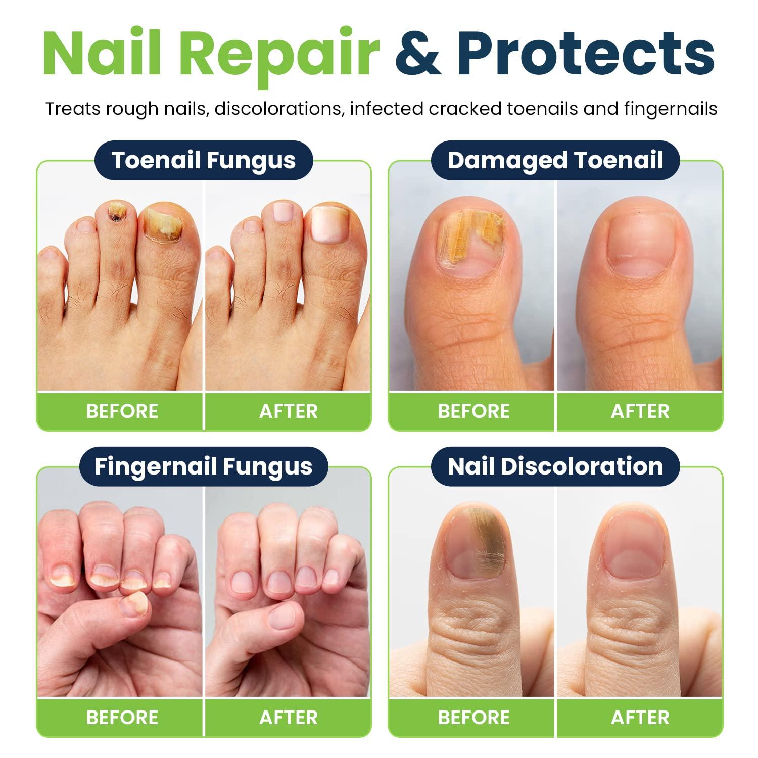 Nail Glue Instant Cracked Nail Repair Gel, Nail Treatment Repair Gel, Nail  Repair Glue for Broken Nails, Nail Strengthener Fixer and Hardener for Nail  Extensions Sculpture Gel (8ml) : Amazon.co.uk: Beauty