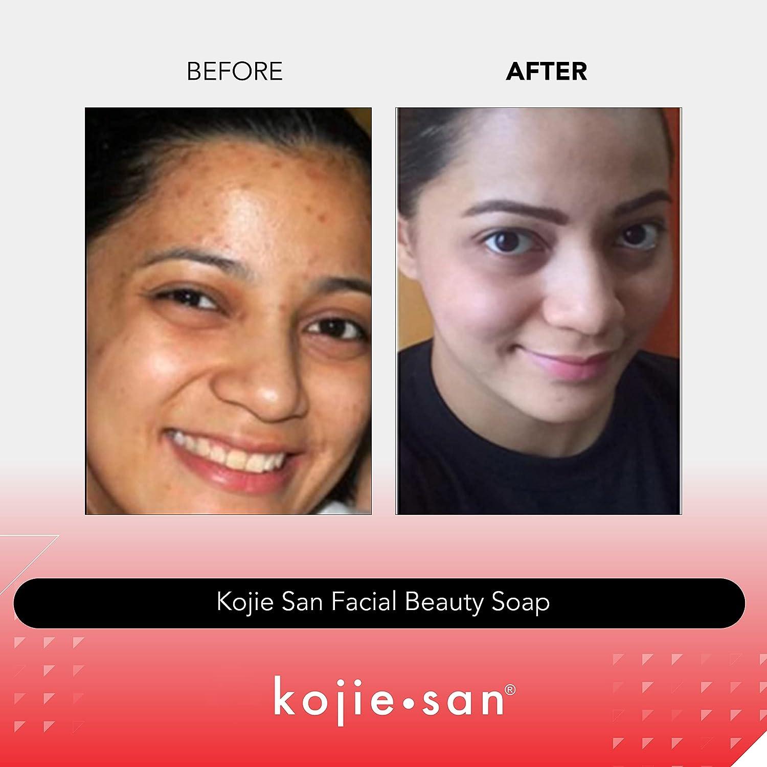  Kojie San Skin Brightening Soap – The Original Kojic Acid Soap  that Reduces Dark Spots, Hyper-pigmentation, & other types of skin damage –  100g x 3 Bars : Beauty & Personal Care