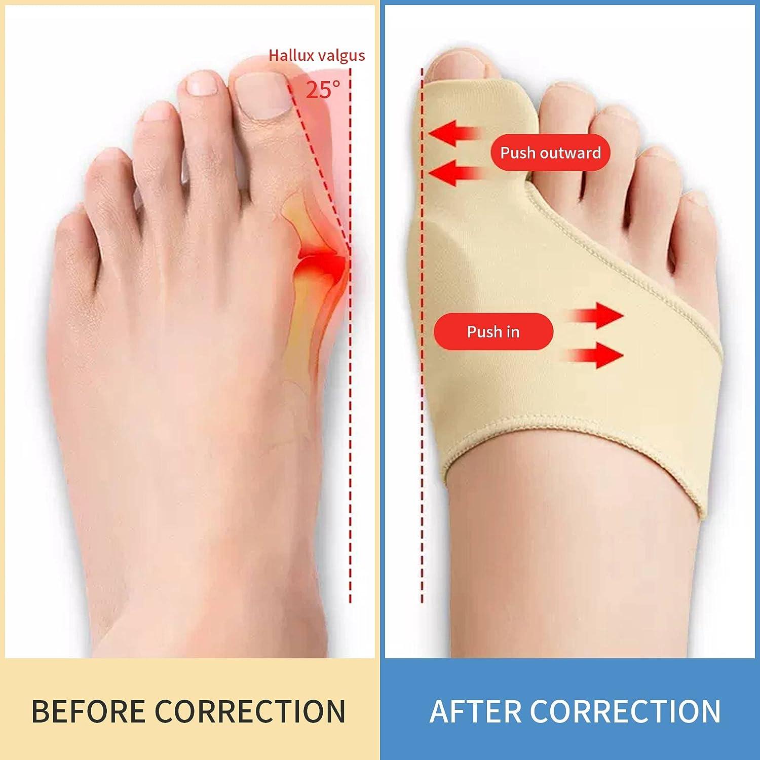 Bunion Corrector for Women and Men Bunion Support Brace Orthopedic