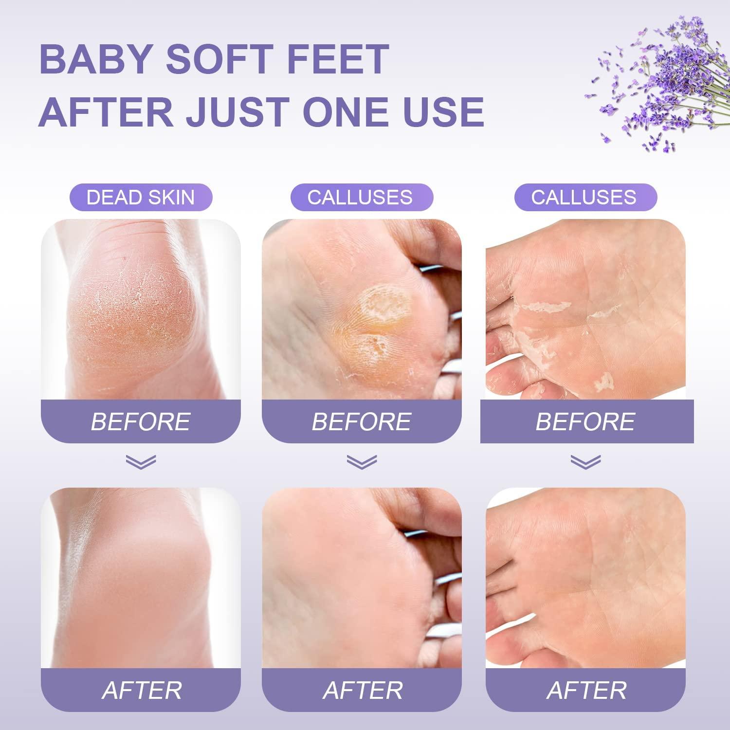 Foot Peel Mask， Exfoliator Peel Off Calluses Dead Skin Callus