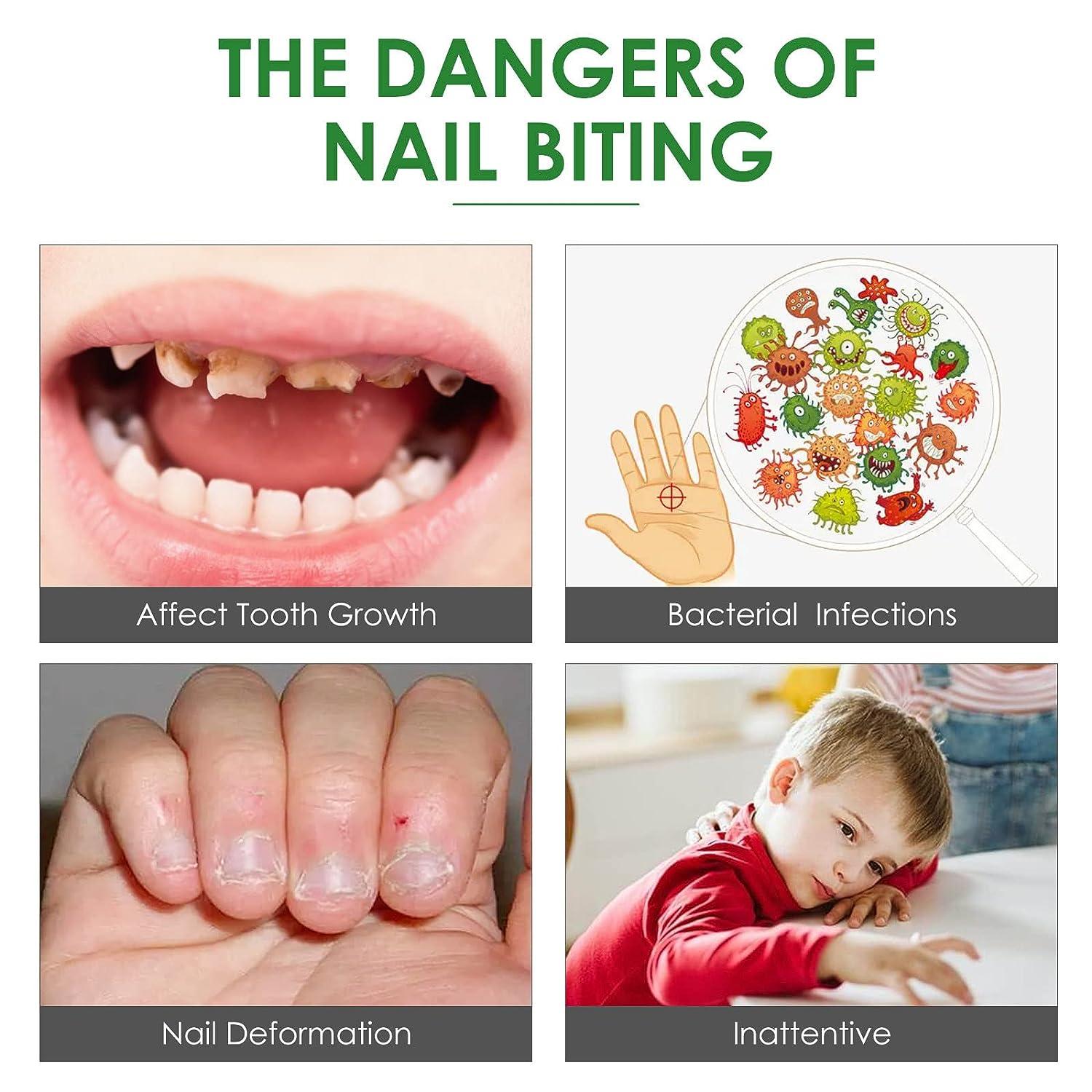 How to get kids to stop biting their nails - Today's Parent