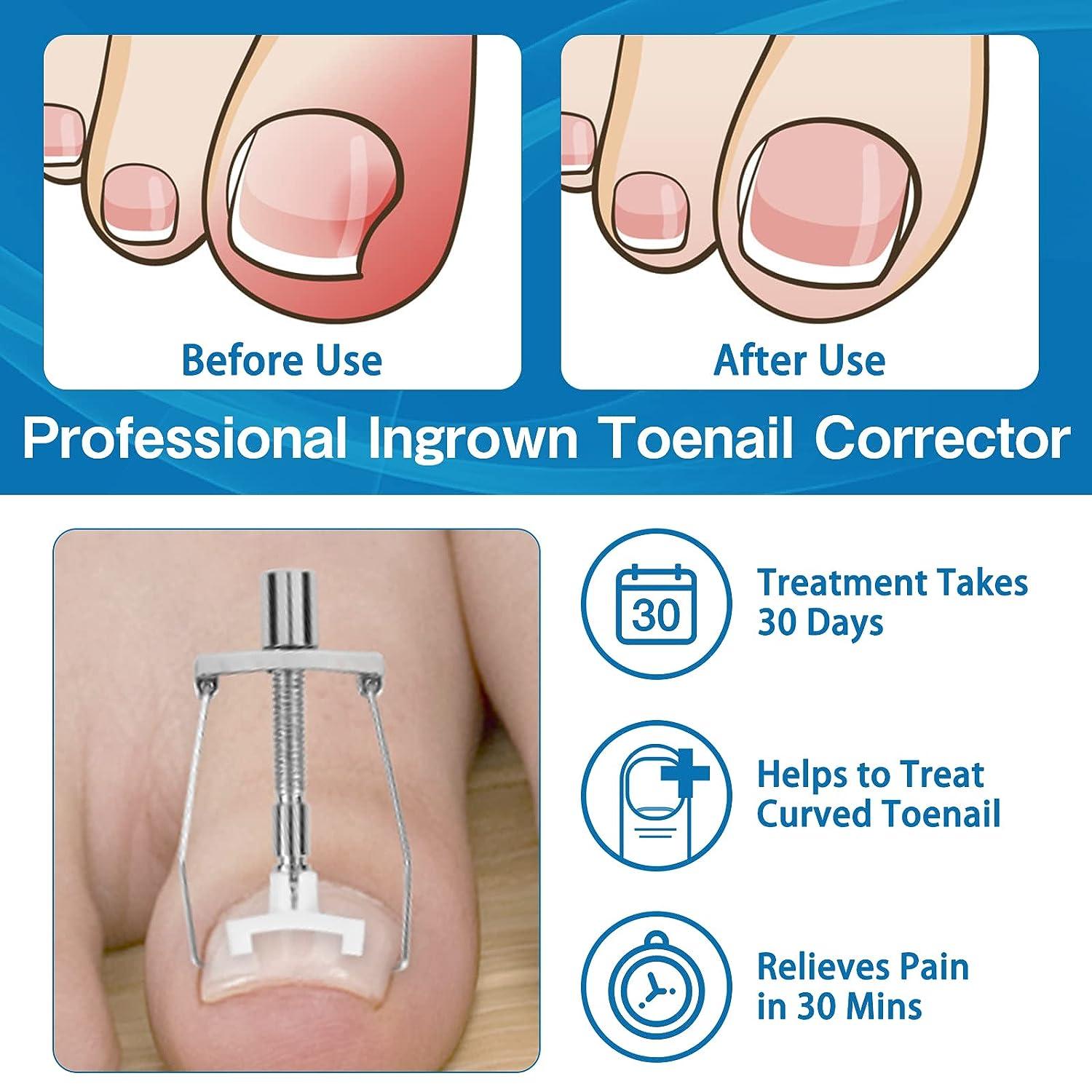 INGROWN TOENAIL TREATMENT, Ingrowing Toe Nail Correction Tool Pedicure  Fungal