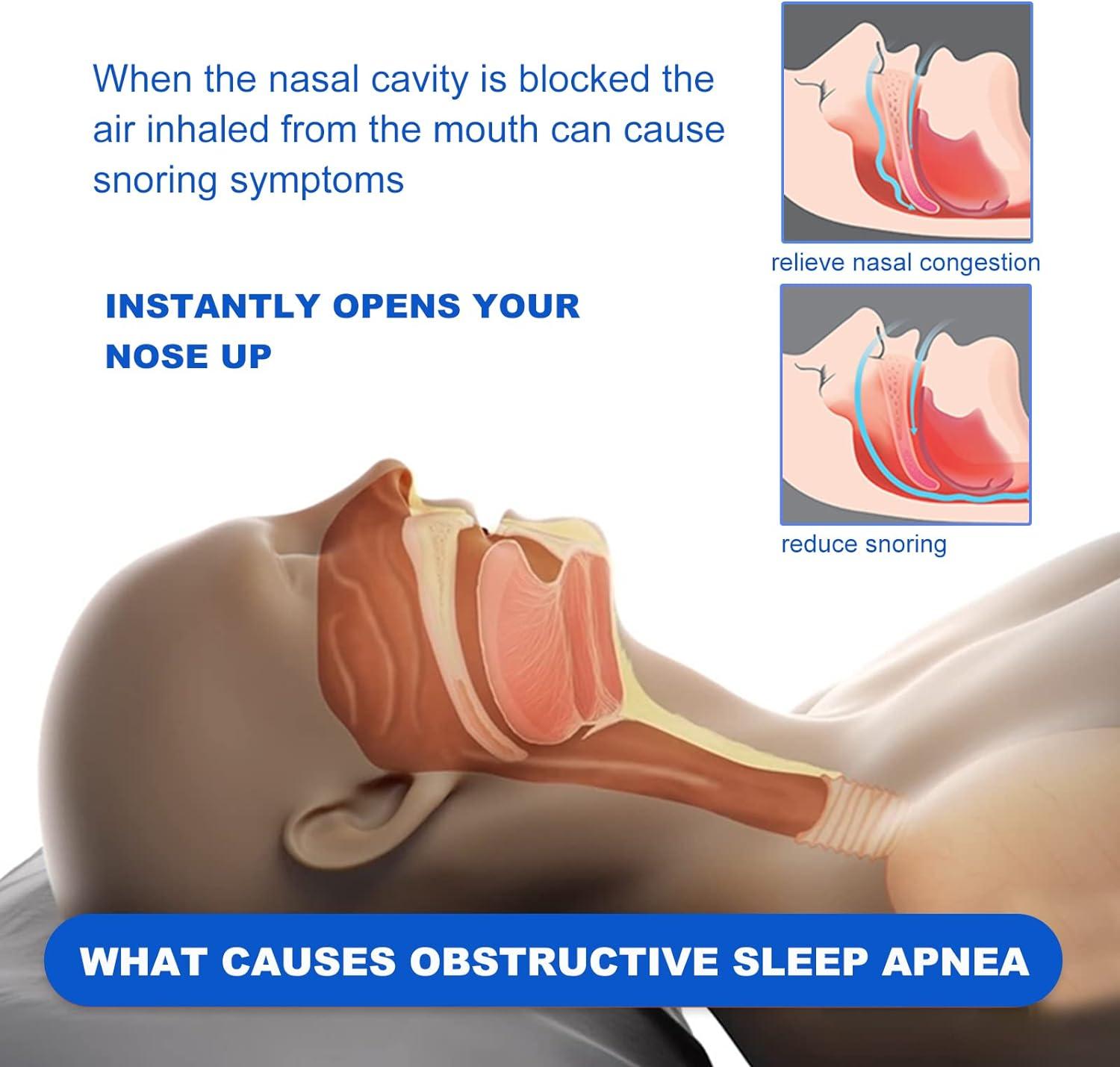 Can Nasal Strips Treat Sleep Apnea?